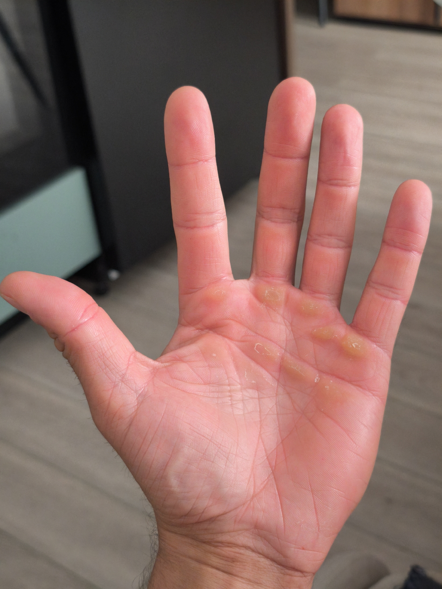 A close-up photograph depicts a male hand, palm up, with several visible blisters on the palm. The blisters are yellowish and appear to contain fluid. The hand is pink in color, with visible lines and creases. The background includes a dark gray cabinet and a light brown wooden floor. No information in the photo indicates a location in Moscow, Russia.