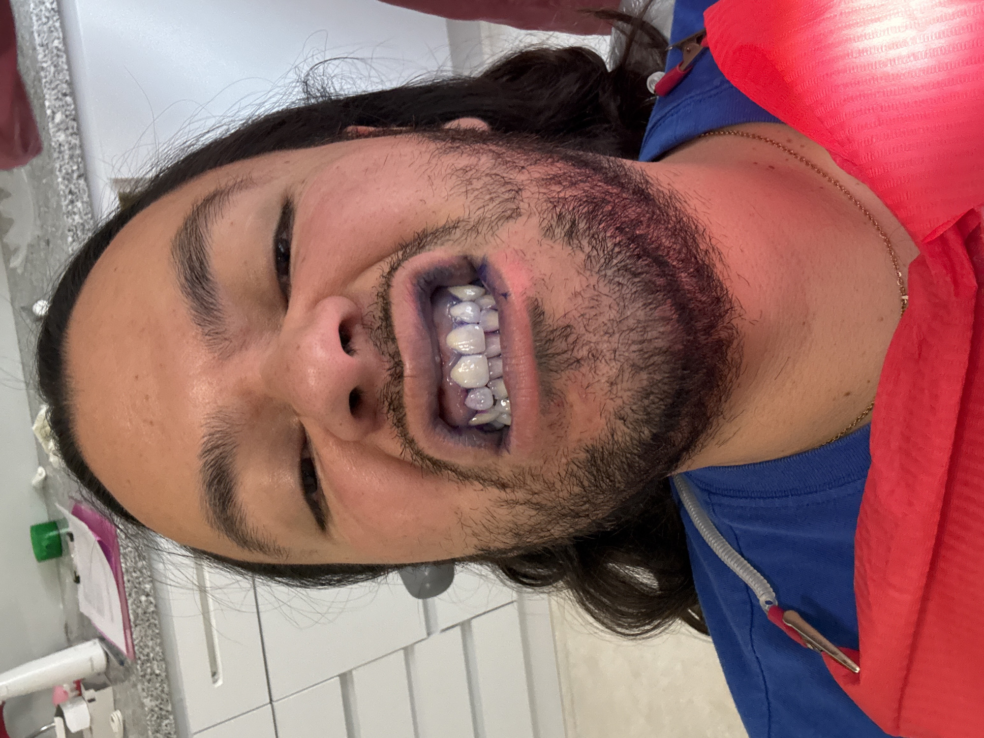 The image shows a man in a dental chair, presumably in a dentist's office. He is wearing a blue shirt and a red dental bib. His teeth appear to have been treated with a blue disclosing agent. The background reveals dental equipment and a white tiled wall. The location within Puebla, Mexico cannot be determined from the image alone.