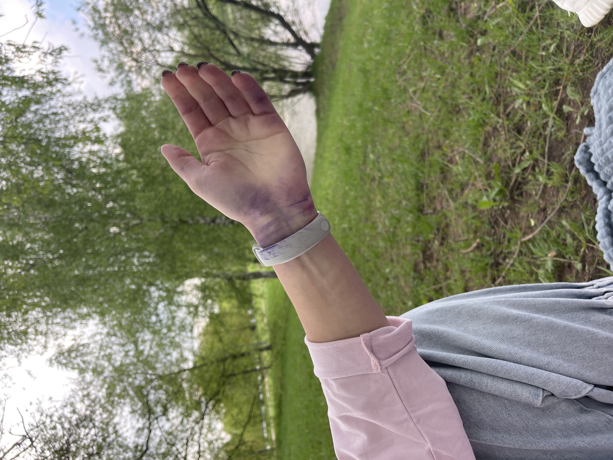 A woman's arm is extended in front of an outdoor, natural environment. The arm is fair-skinned with purple blotches or bruises, particularly on the wrist and back of the hand. A white bracelet with a gray, marbled pattern encircles the wrist. The person is wearing a light pink shirt with the cuff rolled up and is seated, with blue denim clothing partially visible. The background shows a green, grassy area with trees; a body of water is visible in the distance beyond the trees. The location is Moscow, Russia.