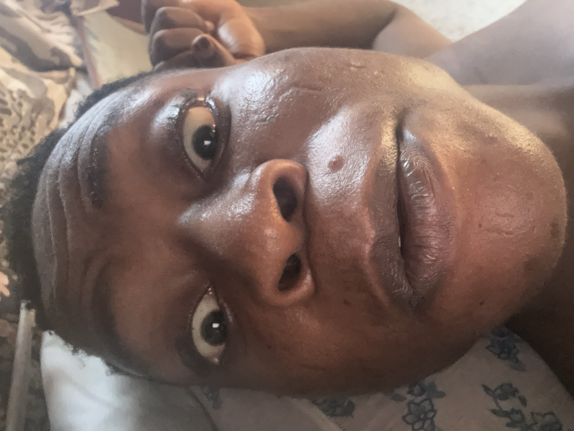 A close-up shot depicts a person's face resting on a pillow. The individual has dark skin, dark hair, and a mole on their cheek. Their eyes are open, and their skin appears moist. The pillow has a light-colored floral pattern.