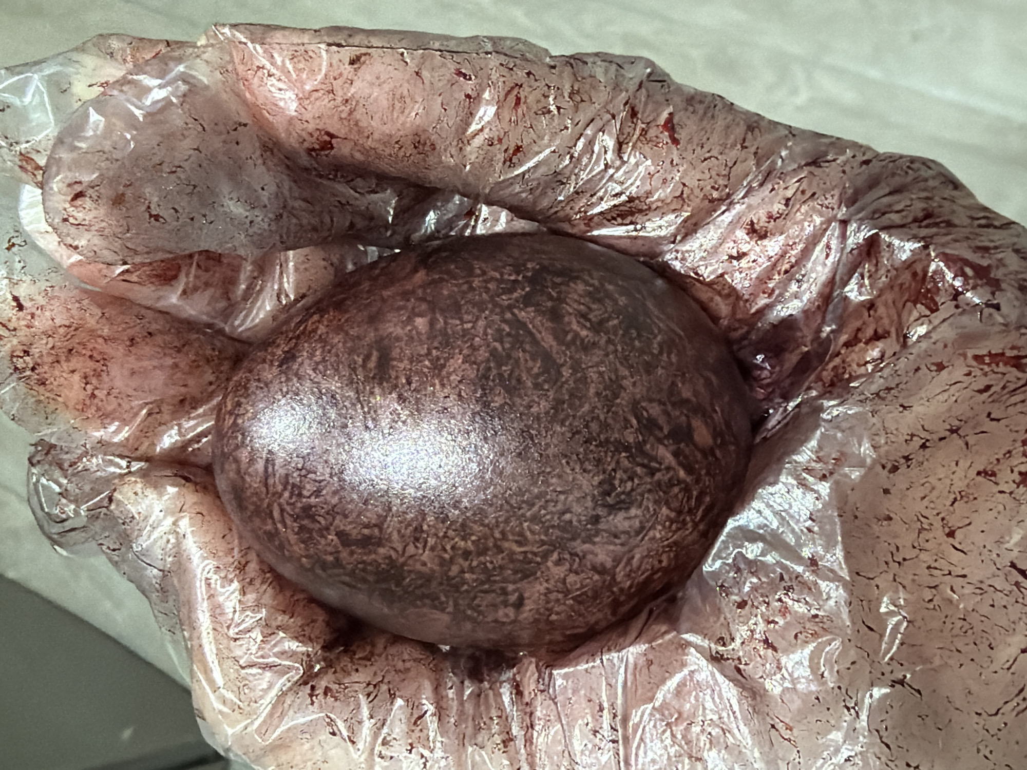 A gloved hand holds a dark, spherical object. The glove is covered in a dark, particulate substance, possibly blood. The environment appears to be a sterile, clinical setting, with a light-colored, possibly metallic, surface visible in the background. No further details indicate the specific location in Chaikovsky, Russia.
