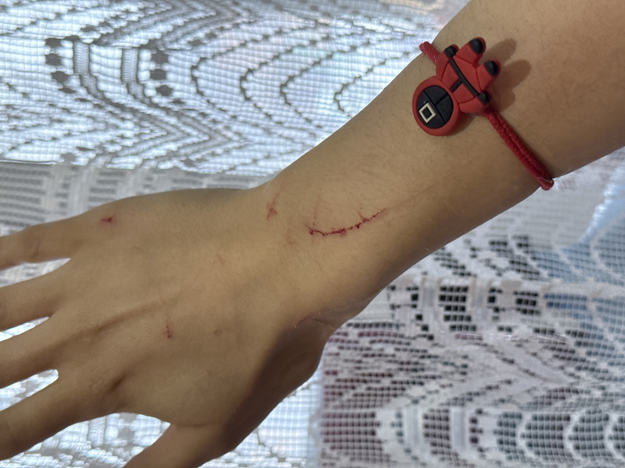 A person's left arm and hand are displayed against a blurred, white lacy background. The arm has several red superficial scratches and marks. A red bracelet with a black and red pendant resembling the shape of a guard from Squid Game is worn on the wrist. The arm is light-skinned. There is no information in the image to indicate the location is in Votkinsk, Russia.