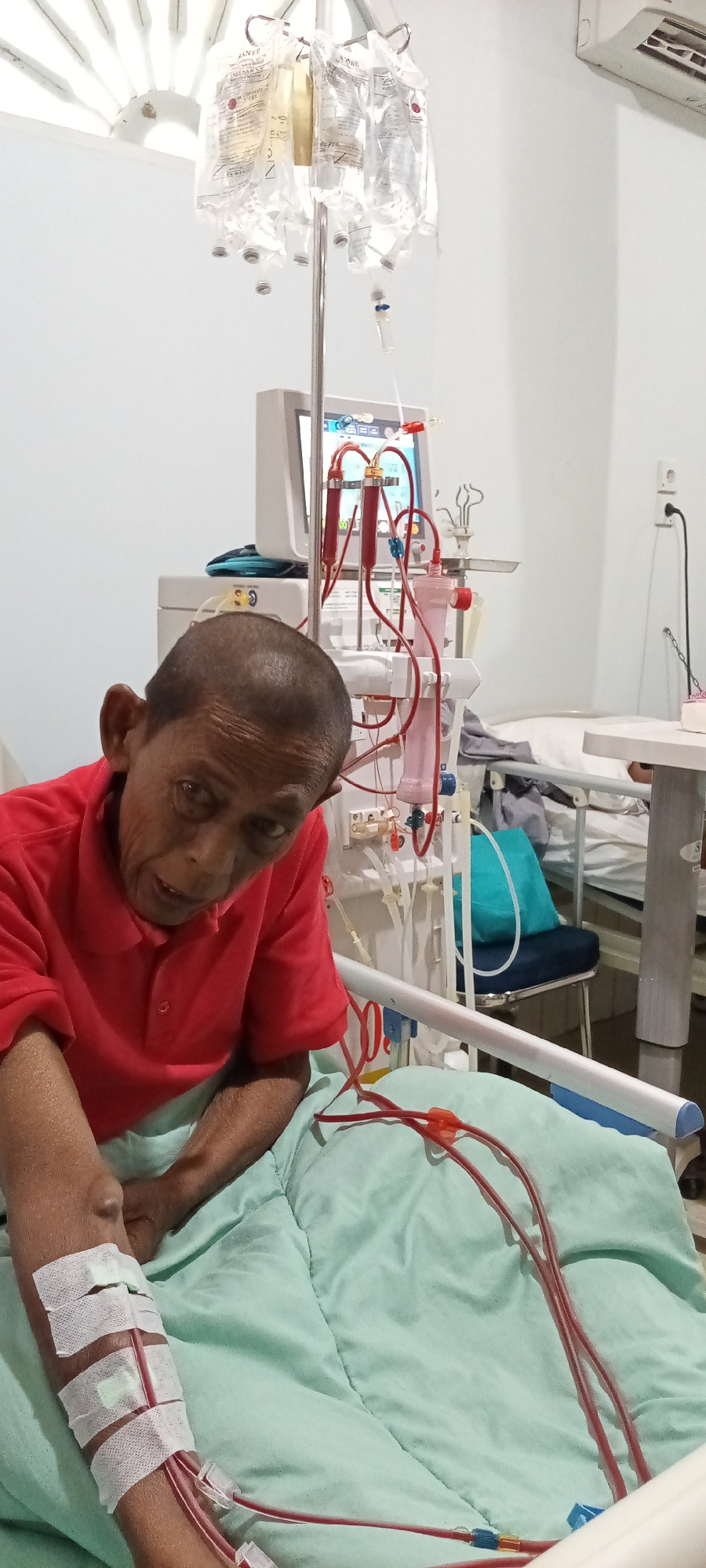 A male individual, appearing elderly, with a close-cropped haircut, is shown in a clinical setting in the city of Lhokseumawe, Indonesia. He is seated on a hospital bed covered with a light green blanket and wears a red collared shirt, looking directly towards the viewer. His left forearm (viewer's right) is visible, with multiple white adhesive bandages securing red medical tubing, indicating an intravenous access site for a medical procedure. These tubes extend across the blanket towards a medical device, likely a hemodialysis machine, positioned to the right of the individual.
The medical machine features a digital screen displaying graphical data in blue and red tones, with additional red tubing and a pink cylindrical component visible. An IV pole stands beside the machine, holding several translucent bags containing clear liquid, some with partially visible labels such as "HANEE."
The background consists of plain white walls. In the upper left, a white, fan-shaped architectural element is visible. An air conditioning unit is mounted on the upper right wall, and an electrical outlet with a black cord plugged in is present on the right wall. To the right and slightly behind the primary subject, a second hospital bed with a white mattress and pillow, and a chair with a blue seat cushion and a teal pillow, are partially visible. The overall scene depicts a patient undergoing medical treatment in a hospital or clinic environment.