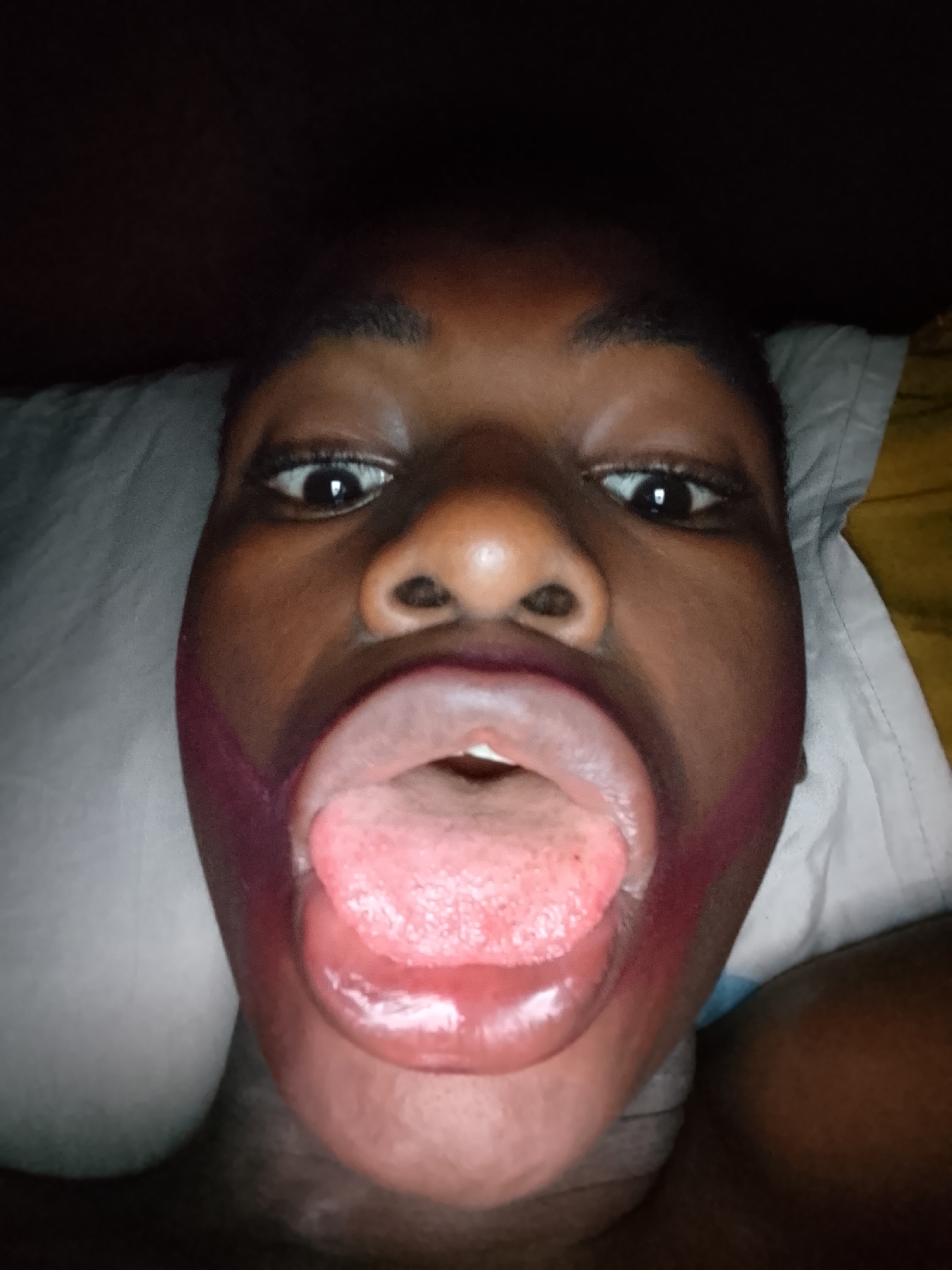 The image presents a close-up, upward-angle shot of a person's face, likely a child or young adult with dark skin, positioned against a white pillow in a dimly lit indoor environment. The location context is Nkpor, Nigeria.
The subject is looking directly at the camera with wide, open eyes. Their mouth is opened very wide, with the tongue fully extended. The tongue is pinkish-red and appears textured, and the back of the throat is visible.
A notable detail is the presence of reddish-purple markings on both cheeks, extending from the corners of the mouth towards the jawline. These marks are prominent and appear to be on the skin. The overall expression, with the wide-open mouth and extended tongue, suggests a playful or exaggerated gesture. The dark background and low lighting imply that the photograph was taken at night or in a poorly lit room. There is no visible text in the image.