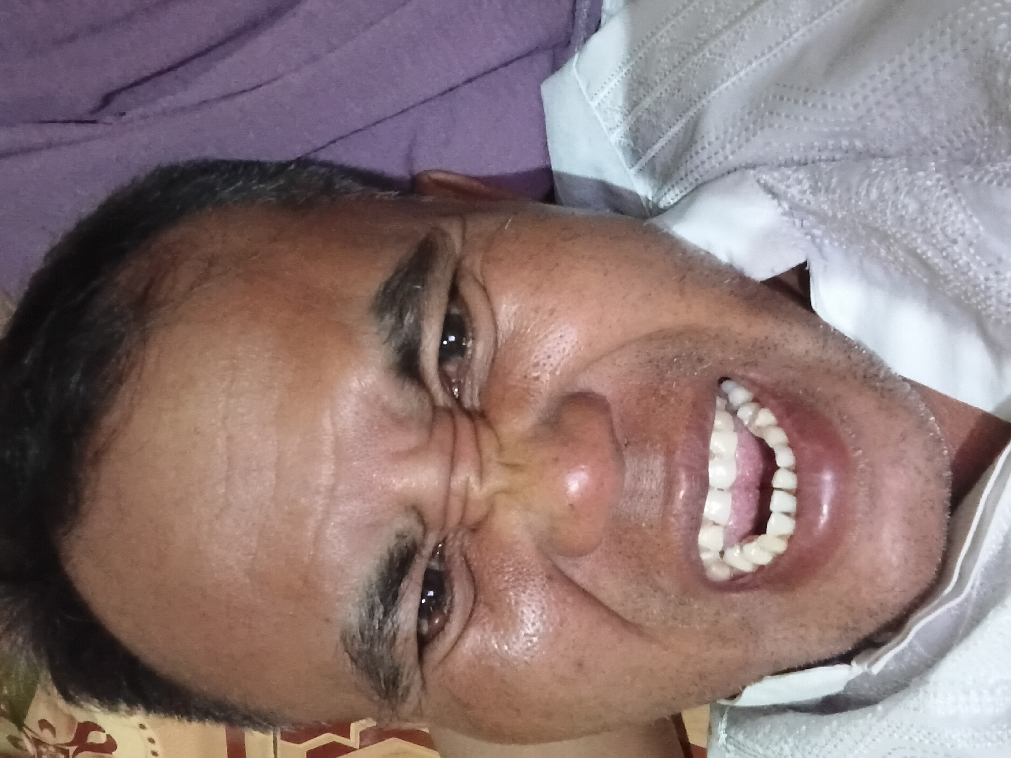 A close-up, rotated portrait shows a person's face in Margo Rukun, Indonesia. The individual is lying down, possibly in a bed, as indicated by the patterned fabric and a purple cloth visible in the background. They are wearing a white shirt with intricate stitching. The person's mouth is wide open, revealing teeth, and their facial muscles are tensed, creating wrinkles around their eyes and nose. The lighting is somewhat harsh, casting shadows and highlighting the texture of the skin.