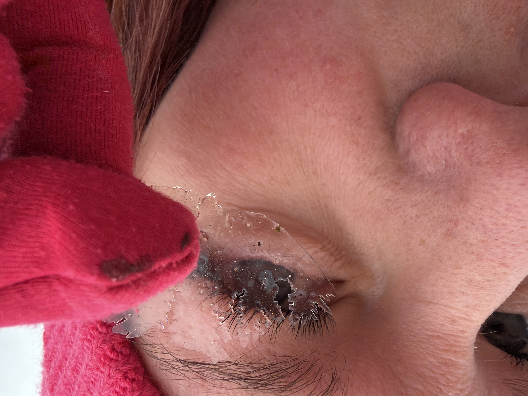 Close-up, tilted view of a person's face with a cracked, semi-transparent layer covering their closed right eye. The layer appears to be adhered to the eyelashes and skin, with rough, jagged edges. A gloved hand, clad in red fabric, is near the eye. The skin is light-toned, and visible forehead wrinkles are present. The location is not discernible from the image. The description is forensic and matter-of-fact.
