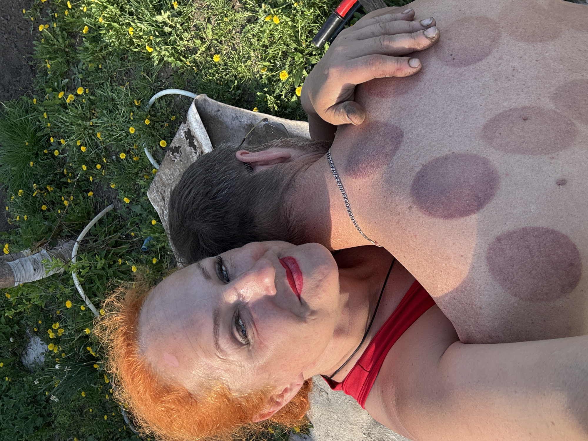 A medium shot shows two people lying on the ground outside near a small dirt-covered wheelbarrow surrounded by dandelions and grass. The camera is positioned at an angle, capturing a woman with bright orange hair, red lipstick, and green eyes, who is lying on top of a man. The man has short brown hair and a silver chain around his neck. His back is covered in circular, purple marks, indicative of cupping therapy. The woman's arm is visible, wearing a red tank top. The background consists of green grass and yellow dandelions. The location and city are unknown.