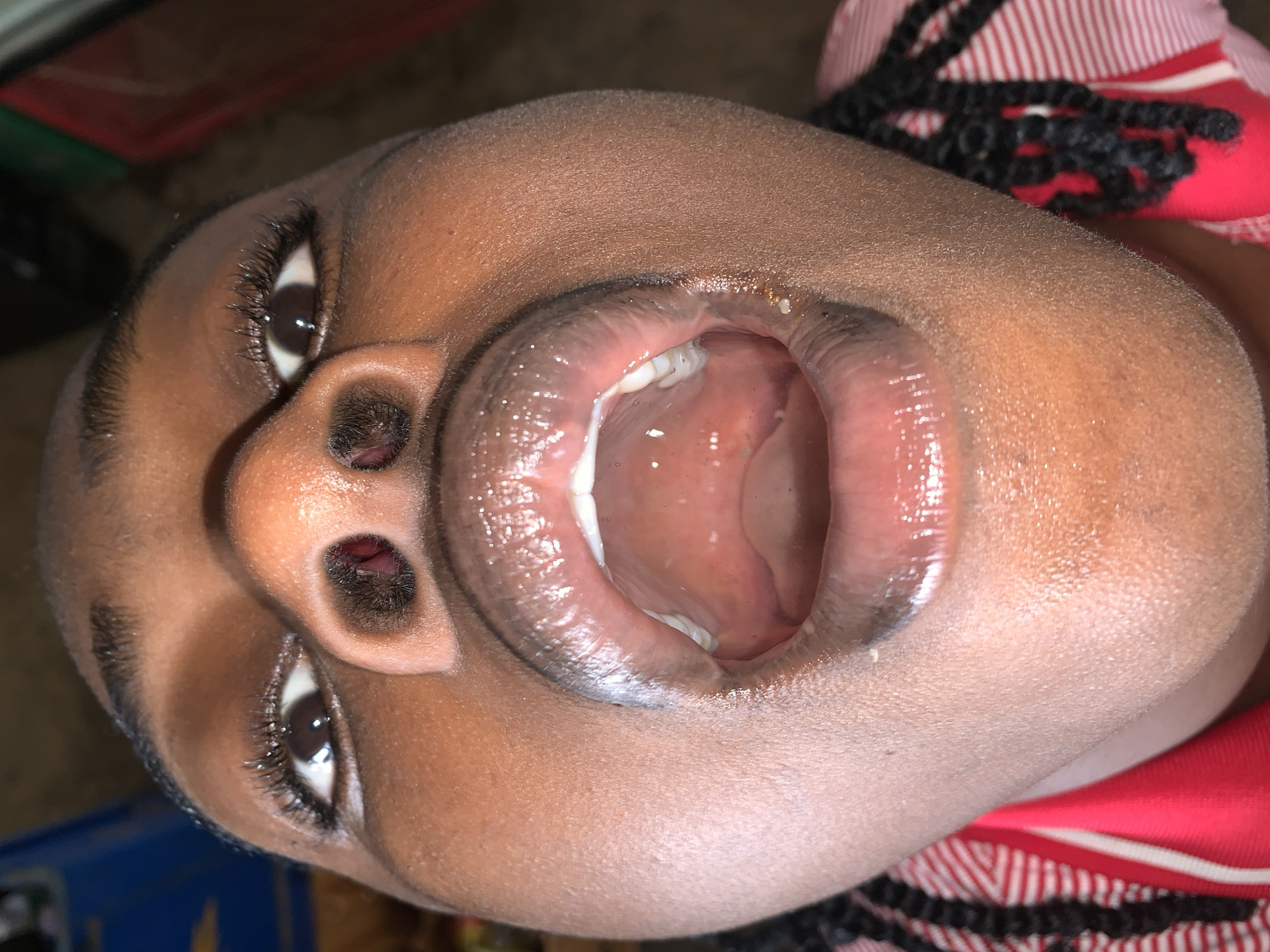 The image, captured in New Stadium, Nigeria, presents a close-up, high-angle portrait of a person, likely a child or young individual, with dark skin. The face is oriented vertically, with the eyes looking upwards towards the top of the frame and the mouth wide open. The person has dark brown skin with visible pores and long, dark eyelashes. Dark pupils reflect an unseen light source. Both nostrils are visible, with fine dark hairs inside.
The mouth is open wide, revealing the pink interior, including the palate and parts of the tongue. Several white teeth are visible in the upper jaw, and what appears to be a developing tooth or gum line is seen in the lower left side of the mouth (viewer's perspective). The lips are full and appear moist, with a prominent white, milky substance visible clinging to the lower lip, gums, and corner of the mouth. This substance suggests saliva, milk, or other residue.
On the right side of the frame, dark, thick braided hair is visible, suggesting a braided hairstyle. Below the hair, a red and white striped fabric is seen, possibly part of clothing or bedding. The background is dark and indistinct, suggesting an indoor setting with dim lighting, potentially indicating evening or night. The wide-open mouth and eyes convey a sense of action or engagement, though a specific emotion is not clearly discernible. There is no visible text in the image.
