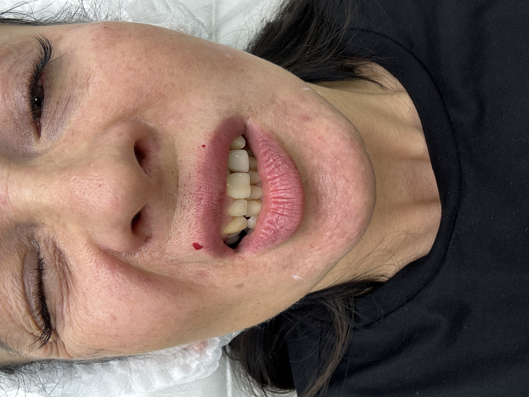 A close-up, inverted view shows a woman lying down, presumably supine. She wears a black shirt. The lower portion of her face is centered, displaying her lips and teeth. A small spot of blood is visible on the left side of her lower lip. Her skin shows signs of aging with wrinkles around her closed left eye. She's lying on what appears to be a white disposable medical paper or fabric. The location cannot be determined as Izhevsk, Russia, without any environmental clues.