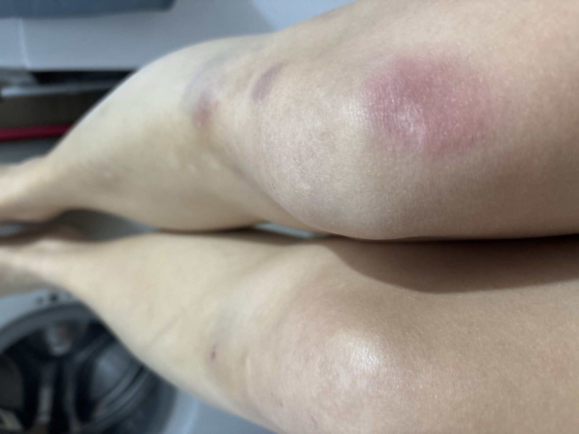 The scene depicts a top-down, close-up view of the bare knees and lower thighs of an individual, observed within a domestic environment in Izhevsk, Russia. The individual's skin exhibits a light complexion. The right knee (viewer's left) shows a minor superficial abrasion located superior to the patella. The left knee (viewer's right) presents a prominent, roughly circular area of acute erythema, approximately 6 cm in diameter, centered on the patella. Superior to this primary area, on the distal aspect of the left thigh, are two distinct purplish-blue contusions, consistent with bruising, measuring approximately 3 cm and 1.5 cm in their largest dimension. A smaller, faint reddish mark is also visible on the medial aspect of the left knee. The background is out of focus, revealing a blurred object resembling a washing machine or similar appliance on the left, and a light-colored wall or surface on the right.
