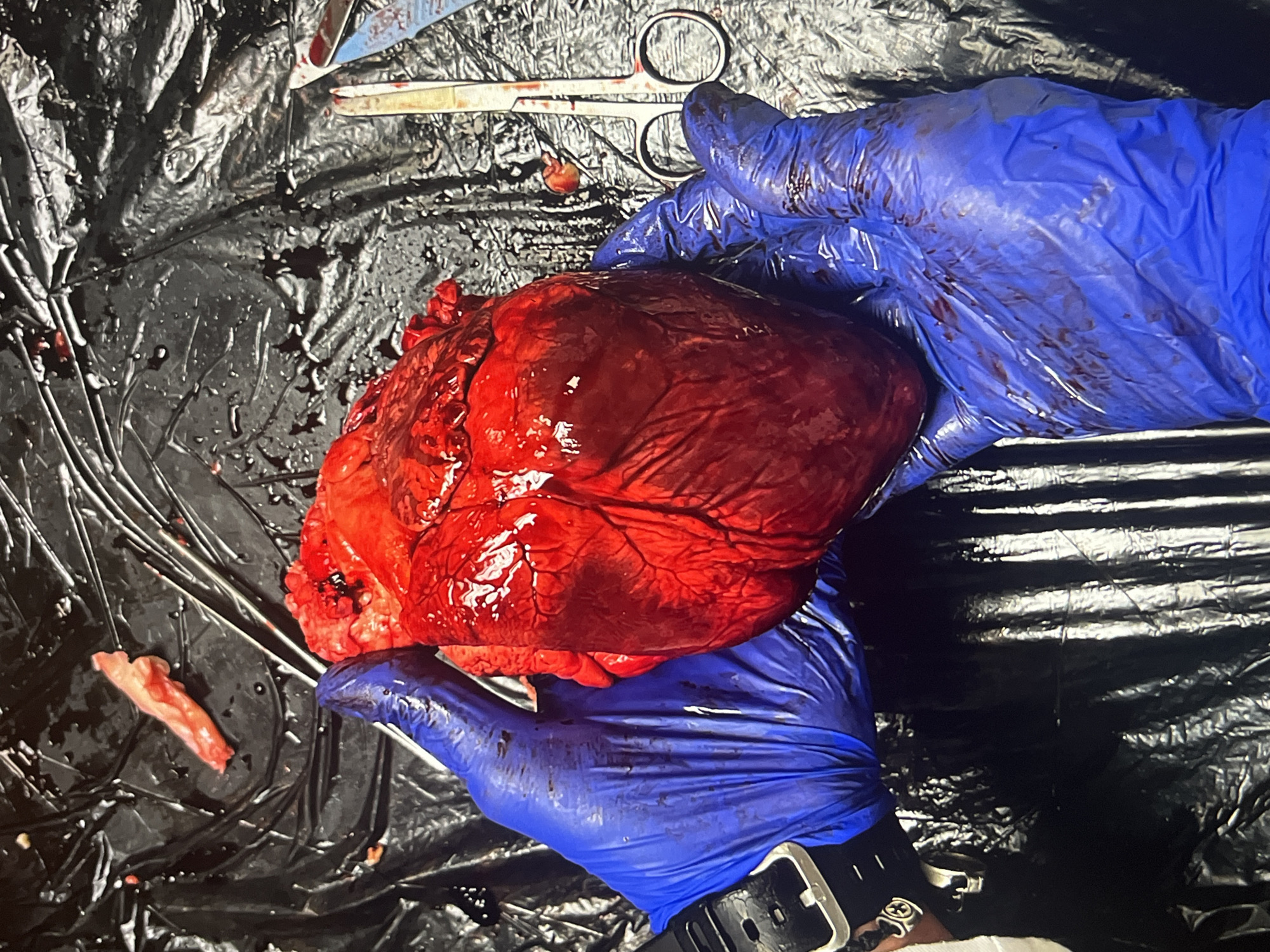 A large, human heart, vividly red and glistening, is held by two hands gloved in blue surgical gloves. The heart displays apparent external vasculature. An unidentifiable person is wearing a watch with a black band on their wrist. Surgical instruments, including scissors and a scalpel, are visible on a glossy black surface strewn with what appears to be blood. An apparent slice of tissue lies to the left. The scene is suggestive of a surgical or post-mortem examination. The city and other locations are unknown.