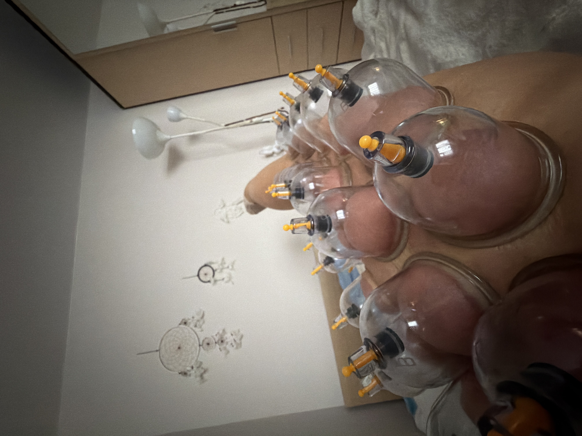 The image shows a person undergoing cupping therapy, with multiple glass cups attached to their back. The cups appear to be creating suction on the skin, causing localized redness. The scene is indoors. In the background, there is a wall with decorative elements resembling stylized flowers or snowflakes. There is also a lamp with multiple lights and a cabinet. There is no direct evidence in the image to confirm this is in Saint Petersburg, Russia.