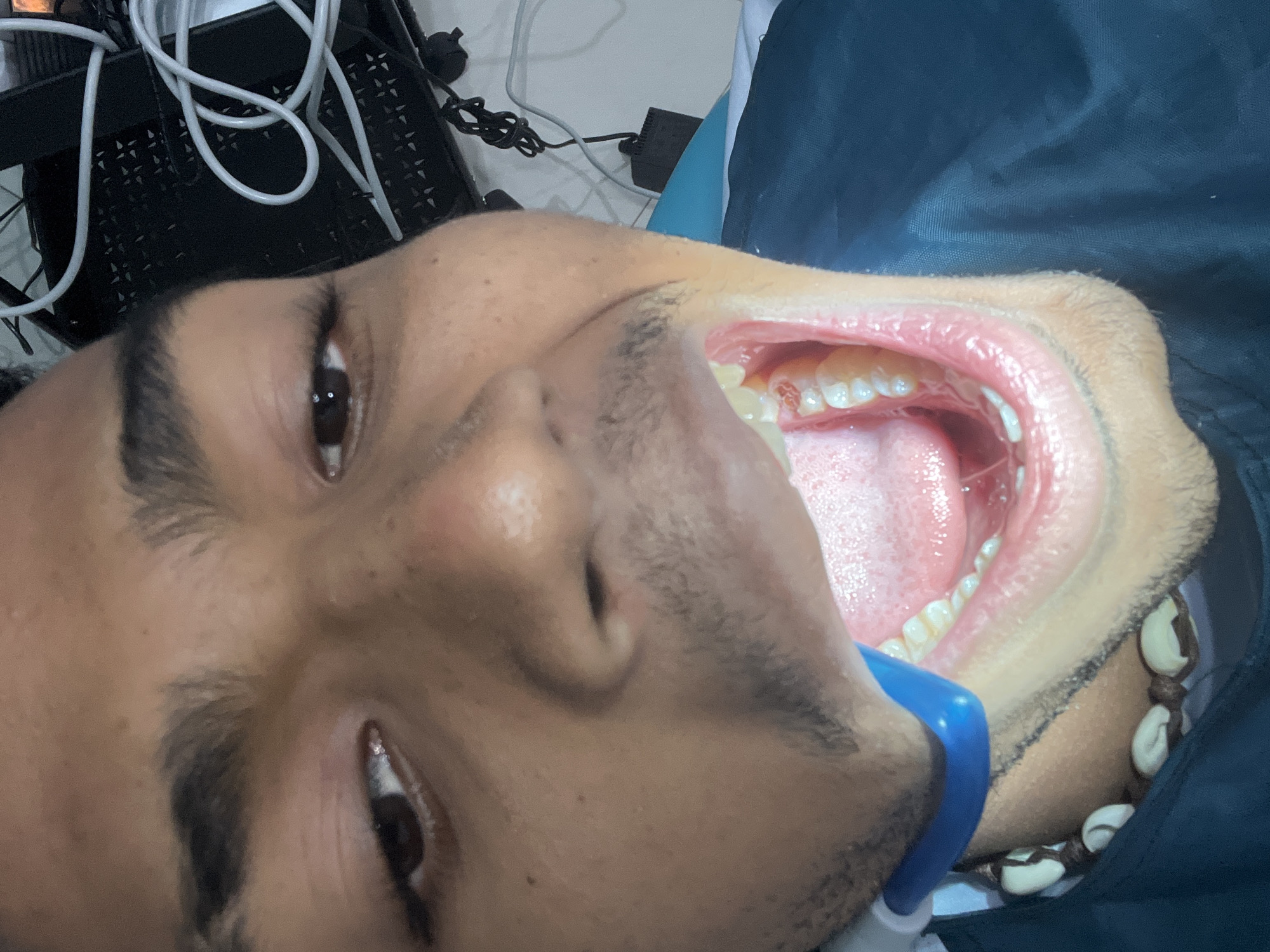 A man is reclined, mouth open wide, at a dental office in La Asuncion, Venezuela. He has a blue bite block between his teeth. His upper and lower teeth are visible, as is his tongue. He is wearing what appears to be a surgical bib, and a beaded necklace with large white beads. Medical equipment and white cables are visible in the background.