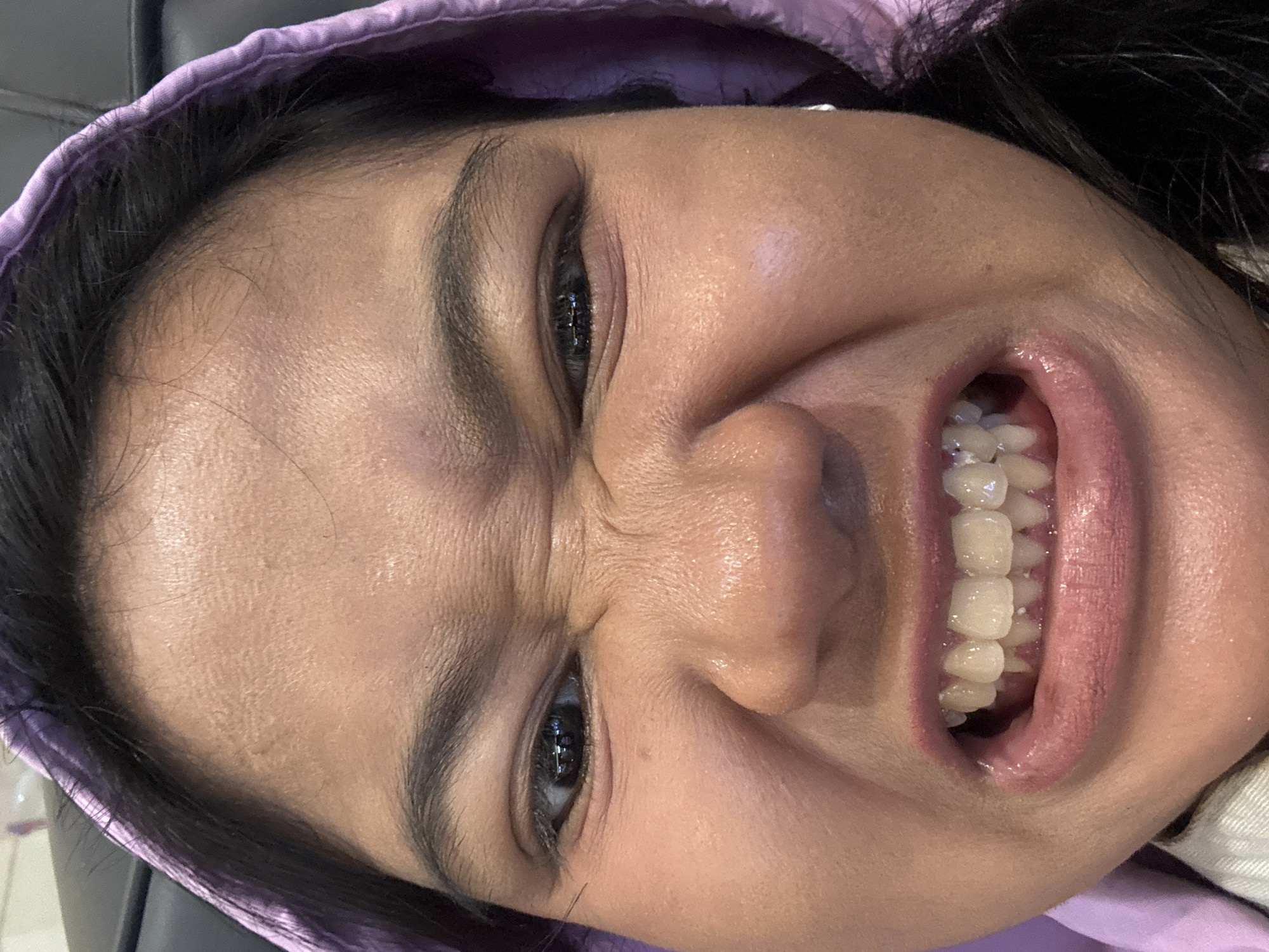 The image shows a close-up, waist-up shot of a person wearing a purple hooded sweatshirt. The person is making a grimacing face, with their eyes squinted and their teeth bared. Their mouth is open, revealing a set of white teeth, some of which appear to have braces. The lighting in the image is bright, and the background is blurred, suggesting that the photo was taken indoors. There are no discernible details about the specific location in North Jakarta, Indonesia.