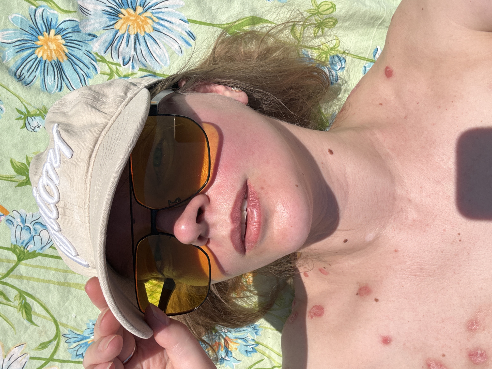 A person is lying on a floral patterned surface, wearing a beige baseball cap with white embroidery and amber-tinted sunglasses. The person's face appears slightly sunburned. Red, slightly raised lesions are visible on their chest. The location is not identifiable as Izhevsk, Russia based solely on this image.