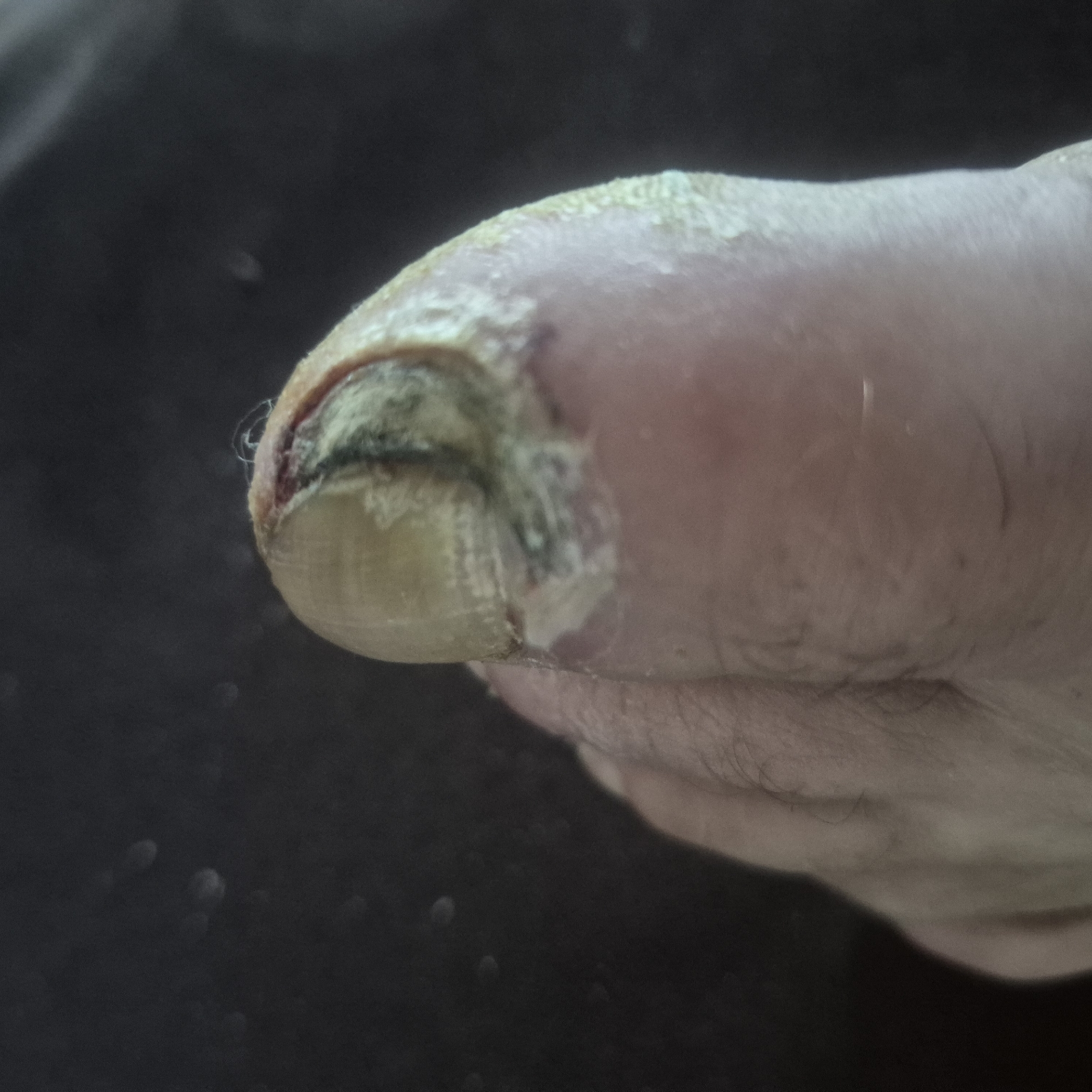 The image shows a close-up view of a discolored and thickened toenail, likely affected by a fungal infection or other condition. The nail appears yellowish and has a rough texture. There is also evidence of inflammation or irritation around the nail bed, with some whitish, scaly patches visible on the surrounding skin. The background is dark and out of focus, making it difficult to discern any specific environmental details.
The image is not geotagged and does not contain any information that would allow for its placement in Kępno, Poland. The subject of the image is a human foot, specifically a toe, and there are no people, actions, or interactions depicted. The scene is a close-up of a medical condition.