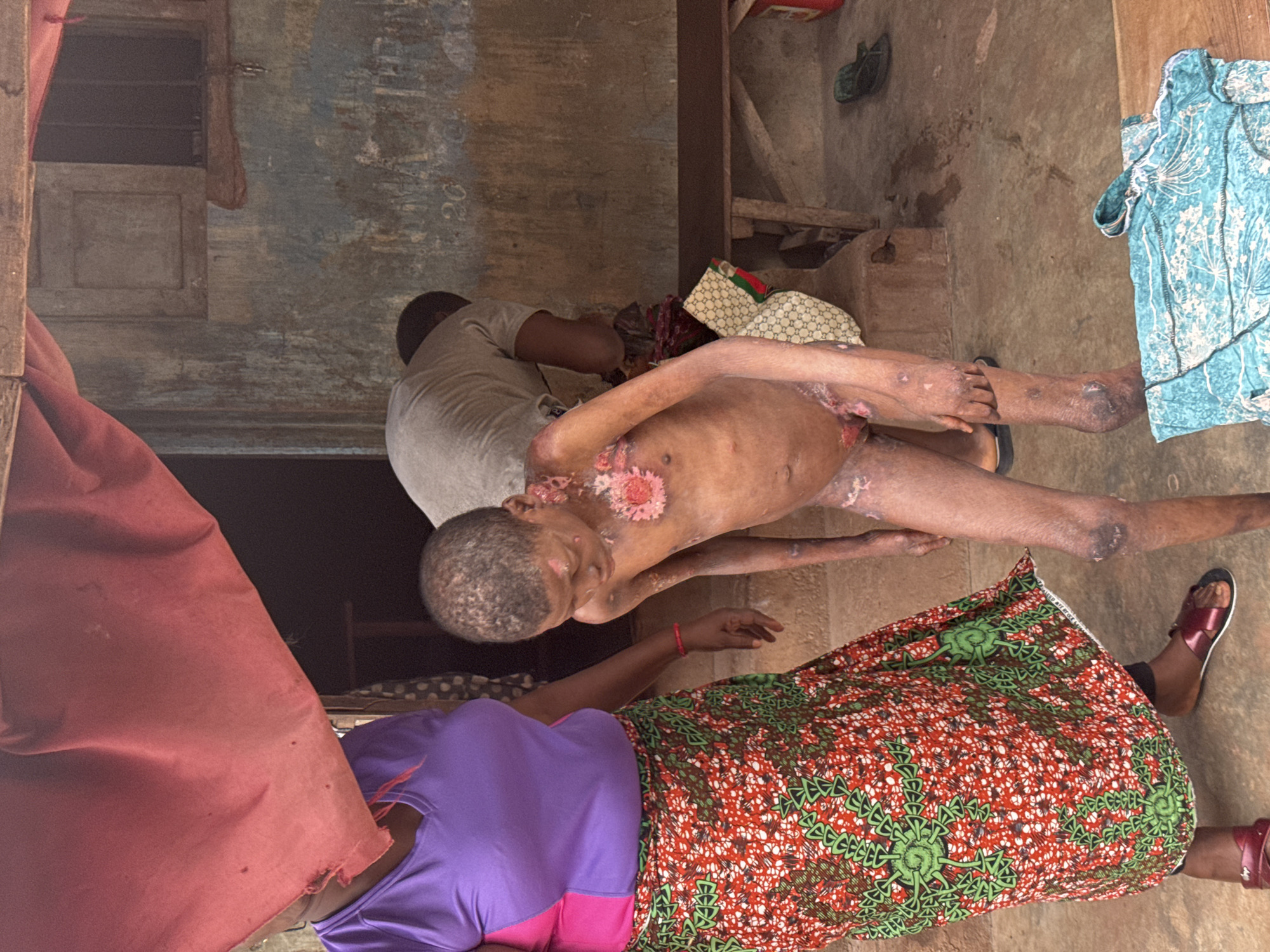The image depicts an indoor scene in what appears to be a simple dwelling, possibly in Enugu, Nigeria. The primary subjects are two individuals, a child and an adult, with another adult partially visible.
The child, positioned centrally, is lying down and appears to be suffering from severe skin lesions or burns, particularly on their chest and limbs. The skin is visibly irritated and discolored in patches, with some areas appearing raw and inflamed. The child's body is emaciated, and their gaze is directed downwards.
An adult, wearing a light-colored t-shirt, is tending to the child, their head bent over the child. The adult's posture suggests a caring or supportive role. Another adult, wearing a purple shirt and a vibrant red and green patterned skirt, is also present, with their head and upper body visible. They are facing the child and the other adult.
The setting is rustic, with a dirt floor and rough walls that appear weathered. Wooden beams are visible in the background, supporting the structure. To the right, a piece of patterned fabric, possibly a dress or a cloth, is draped. In the background, a small window with a wooden frame and a cloth hanging over it can be seen. There are also a pair of sandals on the floor.
The overall atmosphere suggests a difficult situation, likely related to the child's health condition. The lighting appears to be natural, indicating it is daytime, but there are no clear indicators of the weather. No visible text is present in the image.