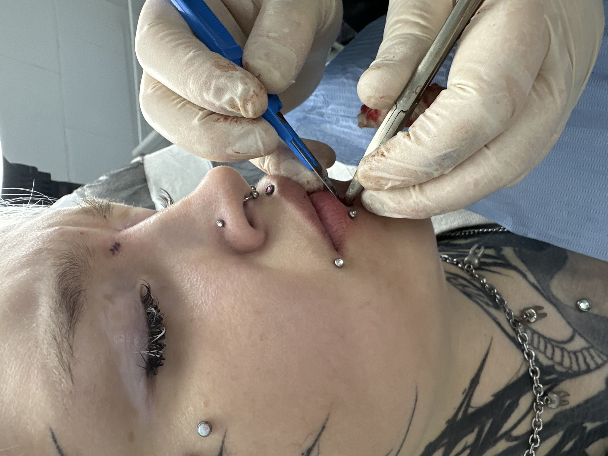 In a close-up, medium-shot photograph taken indoors, a person with multiple facial piercings and extensive dark ink tattoos is the central subject. The person's skin exhibits vitiligo on the left eyelid. They are wearing a silver necklace with tooth-shaped charms. The focus is on the individual's mouth area, where two gloved hands are performing a procedure. One hand holds a blue-handled instrument, possibly a surgical scalpel, near the person's lower lip. The other hand holds a metal instrument, likely forceps, also positioned near the lip. There is visible blood on the instruments and surrounding tissue, indicating a medical or body modification procedure is in progress. The background is blurred but suggests an clinical or sterile environment, with a blue disposable sheet visible. The location is identified as Saratov, Russia.