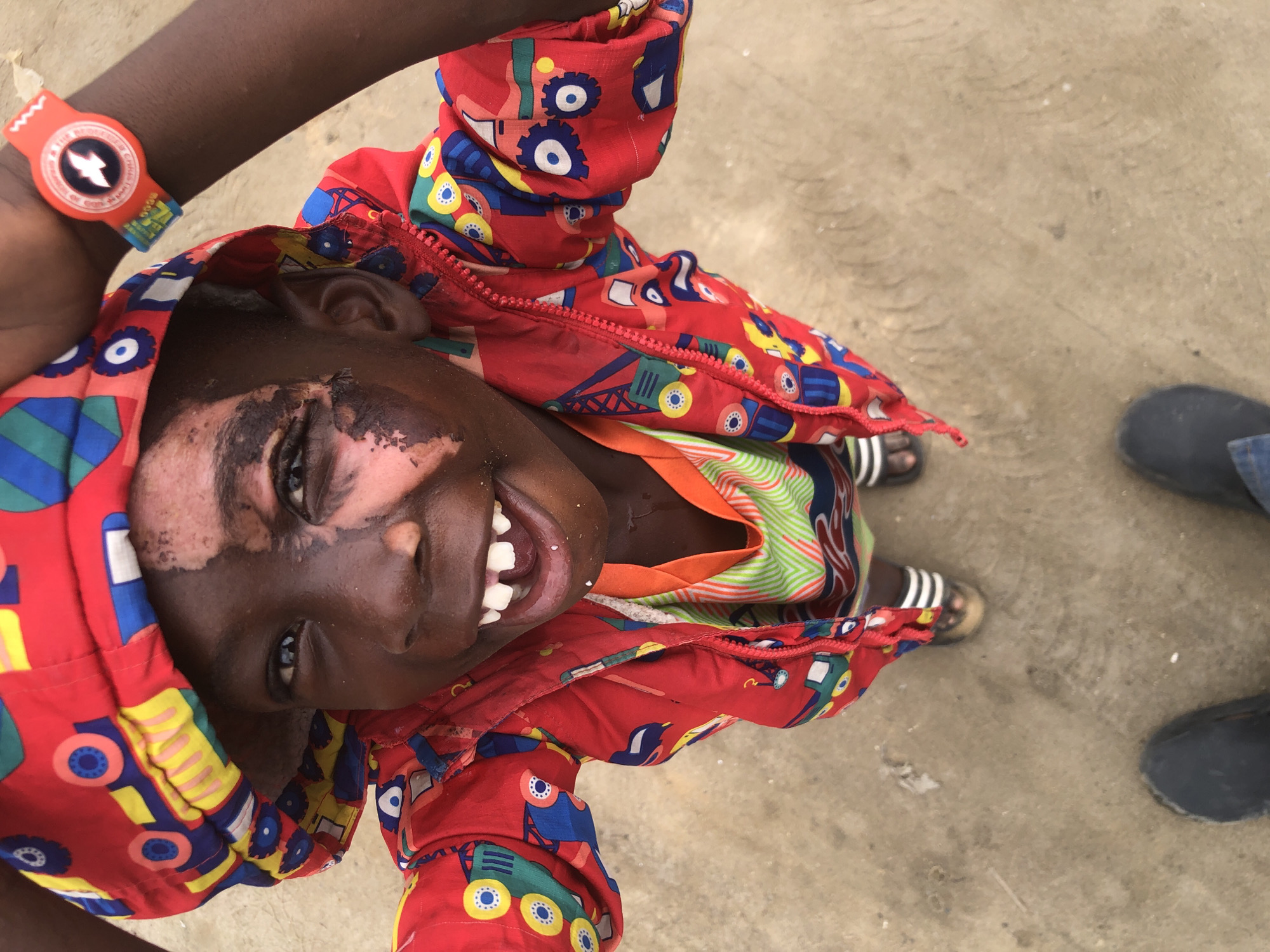 In Ado, Nigeria, a young Black child is captured from a high-angle, downward perspective. The child is wearing a vibrant red hooded jacket adorned with a colorful pattern of trucks and construction vehicles. Beneath the jacket, a glimpse of a green and orange patterned shirt is visible. The child has a wide, toothy grin, and their face features a distinct patch of lighter skin pigmentation on the left side, extending from the forehead to the cheek. A red wristband with a lightning bolt emblem is worn on the child's right wrist. The child is standing on a neutral-colored, textured ground, possibly dirt or concrete. Dark-colored shoes are visible at the bottom of the frame. The overall impression is of a candid, joyful moment.