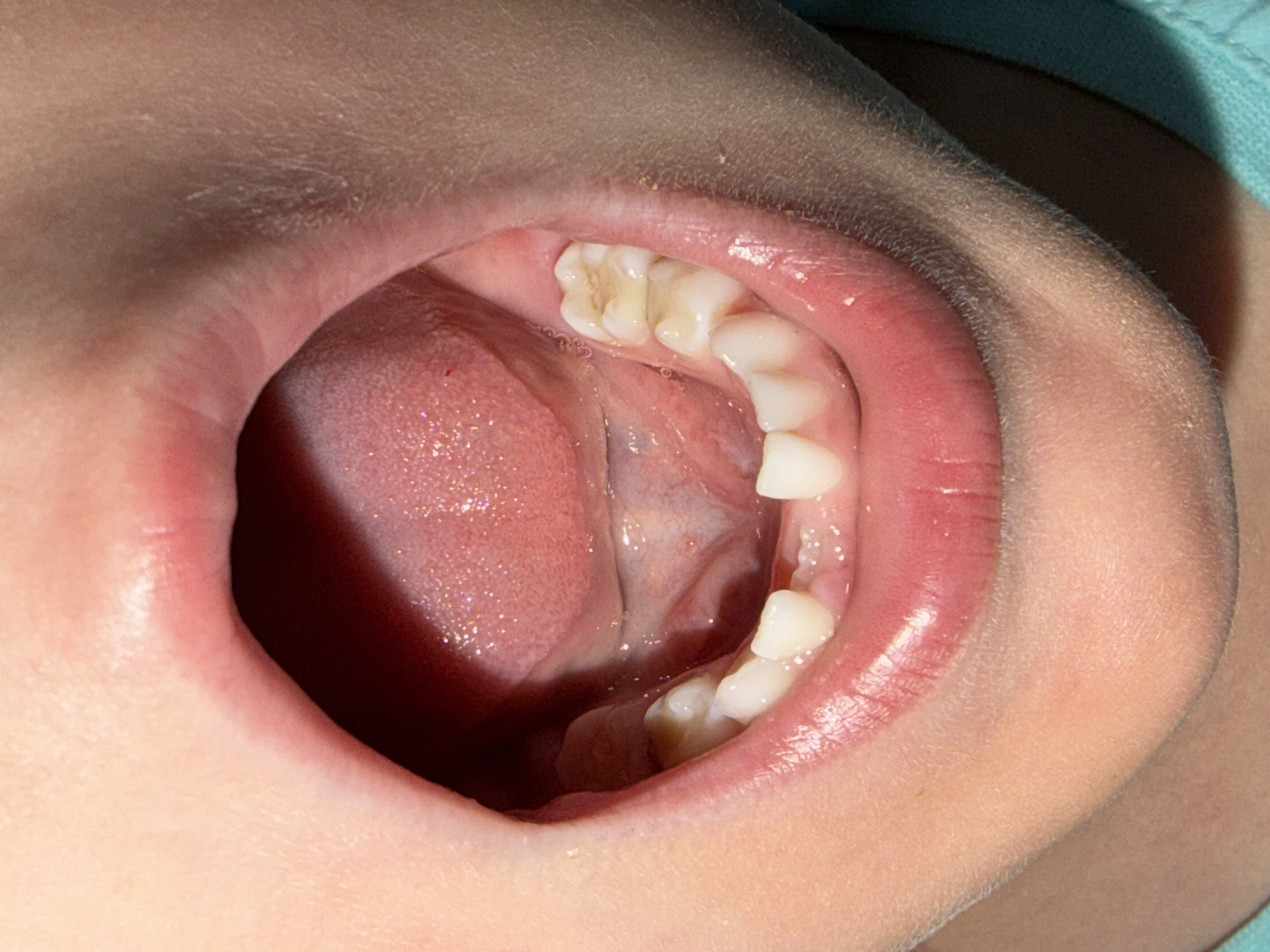 A close-up view of a child's open mouth. The tongue and gums are visible, as well as several teeth, including one molar that appears discolored. The skin around the mouth is light in color. The image does not contain information to indicate a specific location in Chaikovsky, Russia.