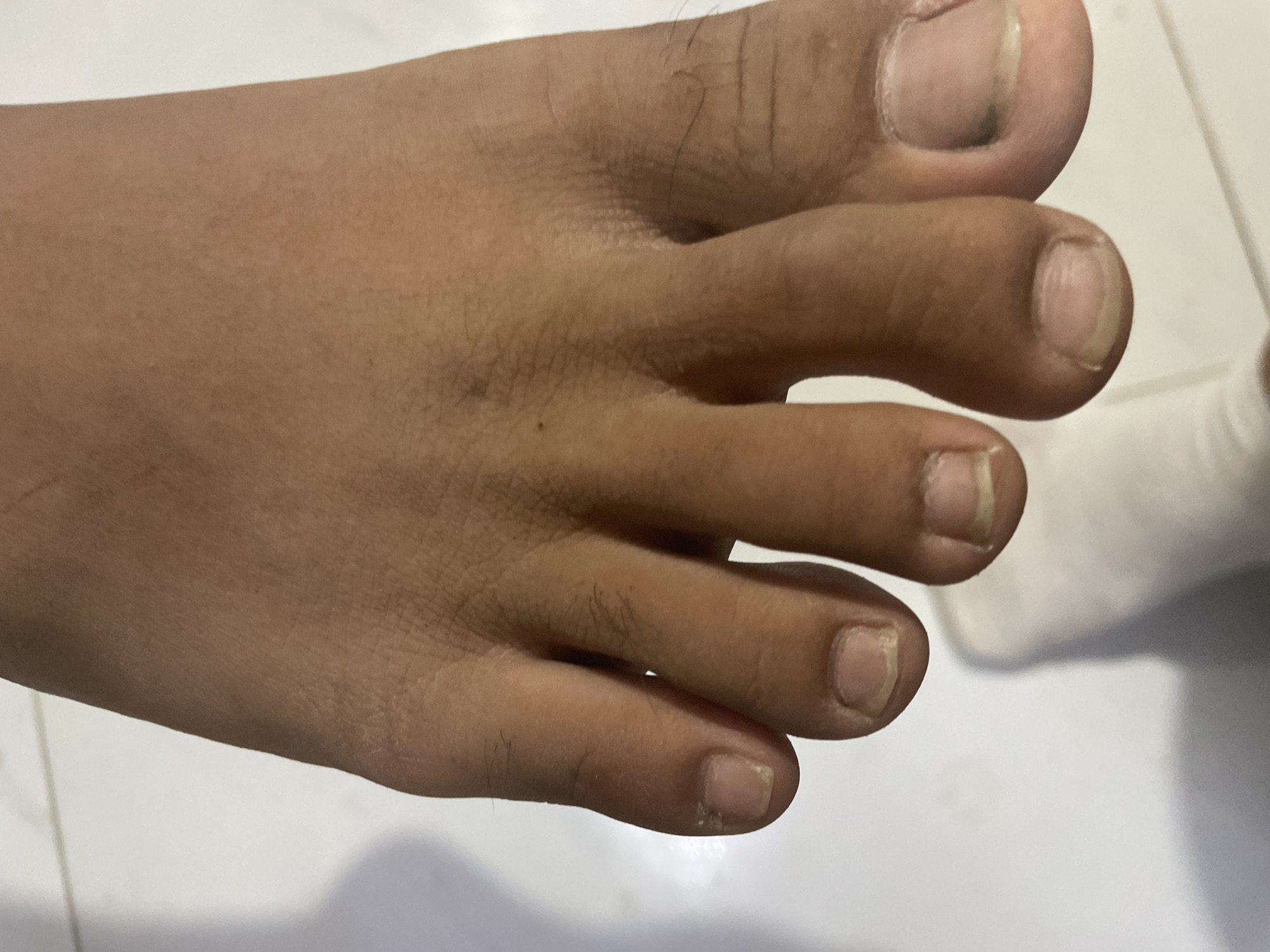 The image shows a close-up of a human foot, with the toes prominently displayed. The skin tone is brownish, and there is a small mole visible on the top of the foot. Some hairs are present on the toes and foot. The toenails appear untrimmed. The background is a light-colored, possibly tiled surface. There are no elements in the image suggesting the location is Davao City, Philippines.