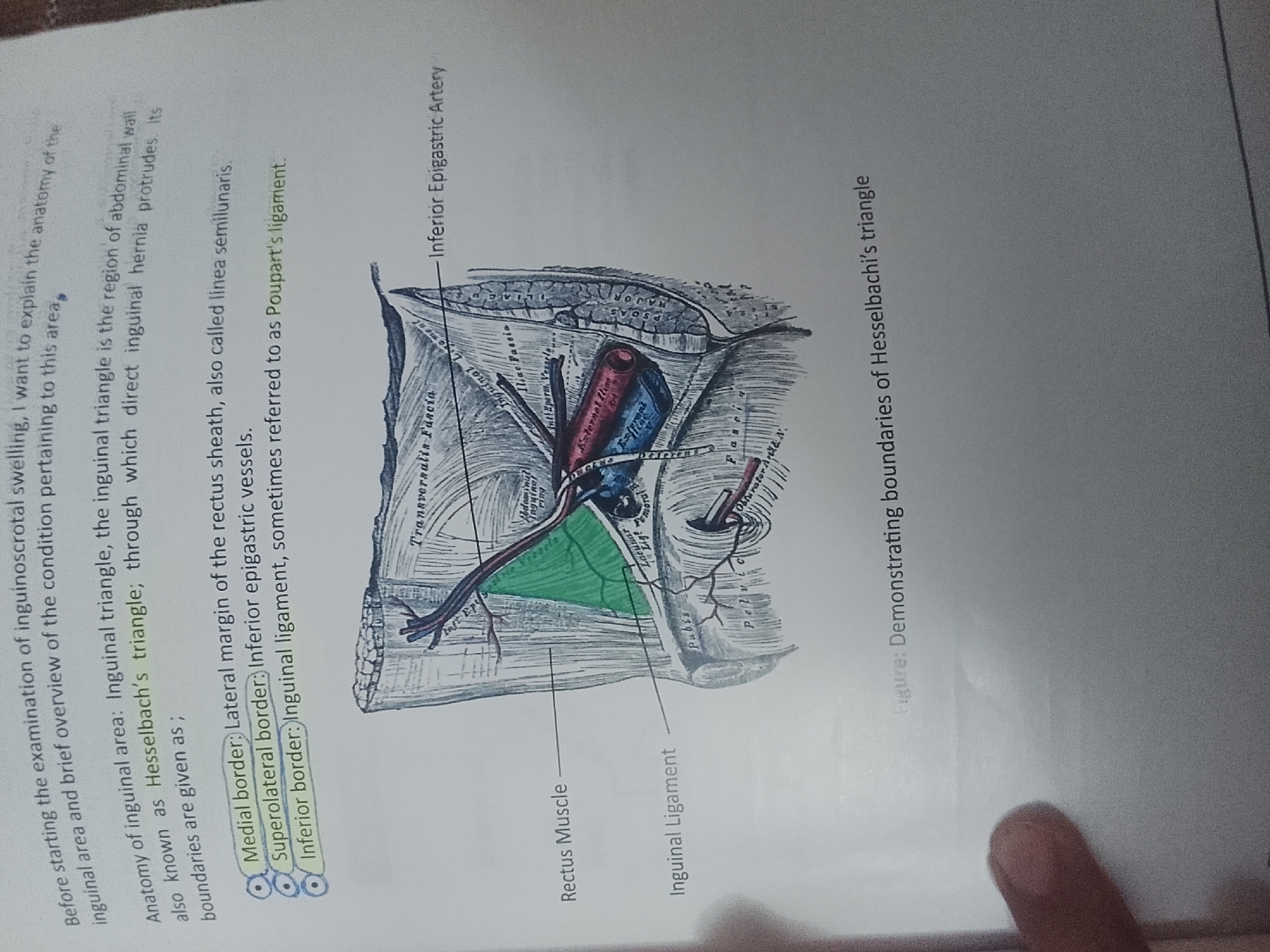 The image is a close-up of a page from a medical textbook, depicting an anatomical illustration of the inguinal region. The illustration shows a diagram of the abdominal wall and pelvic structures, with labels pointing to various anatomical features. The text on the left side of the page describes the inguinal area and the boundaries of Hesselbach's triangle, which are identified as the medial border (lateral margin of the rectus sheath), superolateral border (inferior epigastric vessels), and inferior border (inguinal ligament). The illustration itself highlights the rectus muscle and the inguinal ligament in green. The text also mentions that the inguinal triangle is the region of the abdominal wall where direct inguinal hernias protrude. The image is presented in a neutral, factual manner, typical of educational material, and does not depict any recognizable geographical location or urban setting. There are no people, actions, or interactions depicted in the image. The environment is solely that of a printed page.