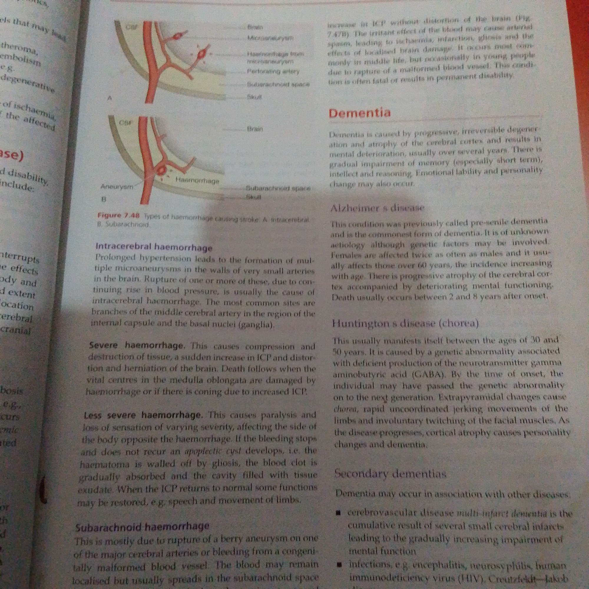 This media file is a close-up, slightly angled shot of a page from a medical textbook. The page contains printed text and two diagrams illustrating types of cerebral hemorrhages. The subjects are the text and diagrams, which are the objects of interest. The scene is a book page, and the setting is implied to be a place where medical education or reference occurs.
The activity taking place is the presentation of information through text and diagrams. There are no people, explicit weather, or time of day cues visible. The location context of Jalingo, Nigeria, is not evident from the image itself.
Notable details include the titles "Intracerebral haemorrhage," "Severe haemorrhage," "Less severe haemorrhage," "Subarachnoid haemorrhage," "Dementia," "Alzheimer s disease," "Huntington s disease (chorea)," and "Secondary dementias." The diagrams are labeled with terms such as "CSF," "Haemorrhage," "Aneurysm," and "Skull." The text discusses medical conditions, their causes, symptoms, and outcomes. For example, it describes dementia as a progressive, irreversible degeneration and atrophy of the cerebral cortex.