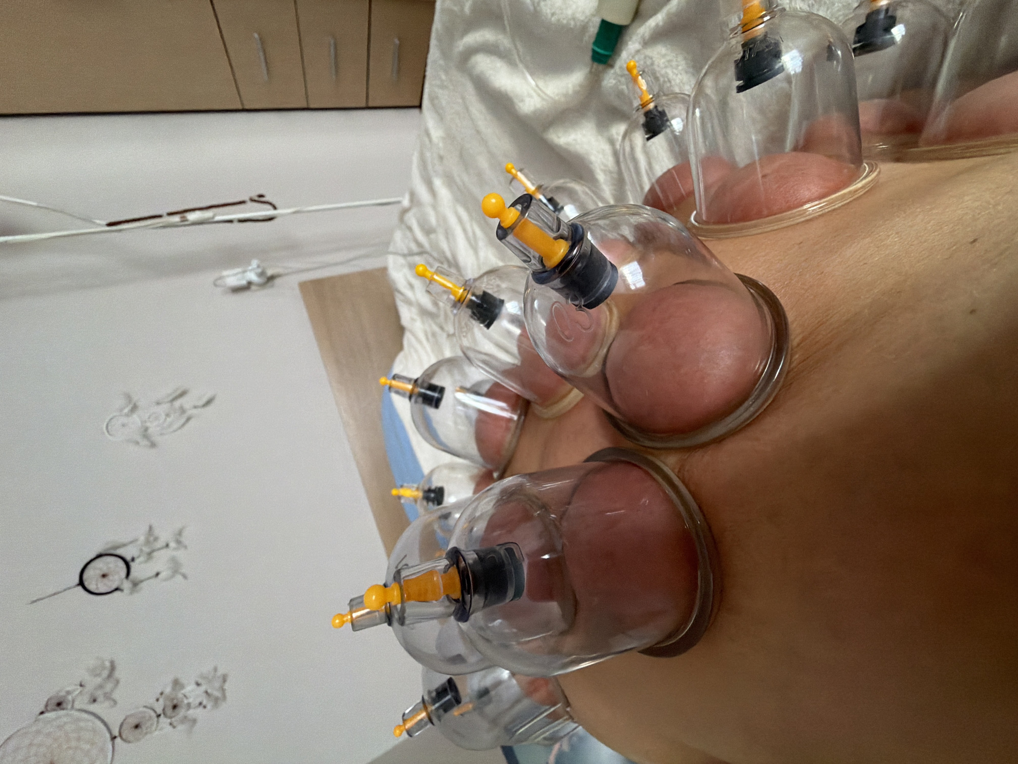 The image shows a person undergoing cupping therapy. Multiple transparent cups with yellow and black attachments are suctioned to the person's skin, creating raised circular areas. The person is lying on a white sheet. The location appears to be an indoor clinic setting. There is a cabinet with closed doors on the wall in the background. There is no evidence to support the location as Saint Petersburg, Russia.