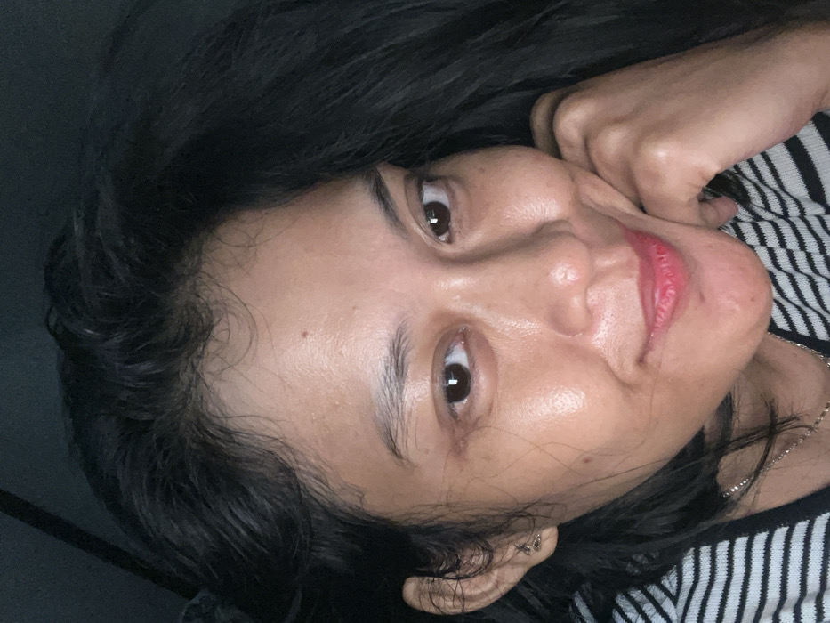A person with dark hair and brown eyes is looking at the camera. Her skin appears oily. She has a mole on her forehead. She is wearing a striped black and white shirt. Her right hand is near her face. The image appears to be taken in low light.