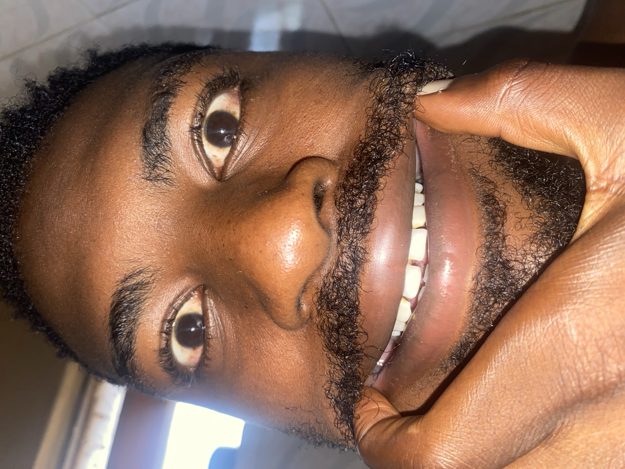 A close-up, upright portrait captures a person, likely male, with dark skin and dark, curly hair, possibly in Jos, Nigeria. The individual is looking directly at the viewer with wide, dark eyes. The whites of their eyes (sclera) exhibit a yellowish-brownish tint, especially towards the inner corners, and some subtle red blood vessels are visible.
The person's right hand, matching their dark skin tone, is engaged in pulling down the lower lip and the skin below the mouth. This action stretches the full, curly beard and mustache, revealing a set of white lower teeth and the pinkish-red inner lining of the mouth. The thumb, with a short, light-colored fingernail, is prominently visible, and the skin on the hand shows natural creases and wrinkles.
The lighting is bright, creating a slight sheen on the person's skin, indicative of an indoor setting with a direct light source, possibly a flash. The background is indistinct, light in color, and out of focus. There is no visible text in the image.