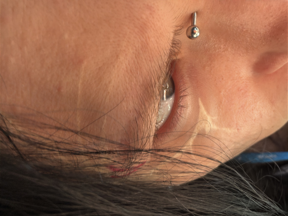 The image displays a close-up, high-angle view of a person's upper right facial region. Dark, straight hair, likely black, frames the left side of the frame, partially obscuring the forehead and temple. The skin exhibits a warm, light to medium tan tone with visible pores and minor texture. Several faint, linear scars are discernible on the forehead and temple area, particularly near the hairline. A small, linear red mark is present on the skin beneath the hair on the far left. The right eye is partially visible, with a light brown iris and discernible pupil, and the gaze is directed slightly downwards and to the left. Eyelashes are present. Below the outer corner of the right eye, in the upper cheek area, a silver-colored barbell piercing with spherical ends is horizontally embedded in the skin. Strong directional lighting from the upper left casts a distinct, somewhat geometric highlight on the skin below the eye. No external environment or specific location within Sofia, Bulgaria, can be determined from this close-up perspective.