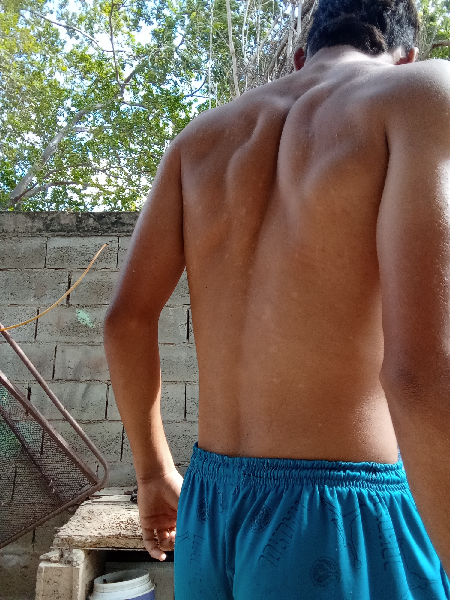 A shirtless male figure is viewed from the back, with focus on the torso and upper arms. The person has a light-brown skin tone, marked with patches of lighter pigmentation on the back. Blue shorts are visible around the waist. The background features a concrete block wall and foliage with hints of sky visible through the trees. A metallic structure is also present near the wall. The scene appears to be outdoors in daytime. This image does not provide sufficient information to confirm a specific location within the city of Juan Griego, Venezuela.