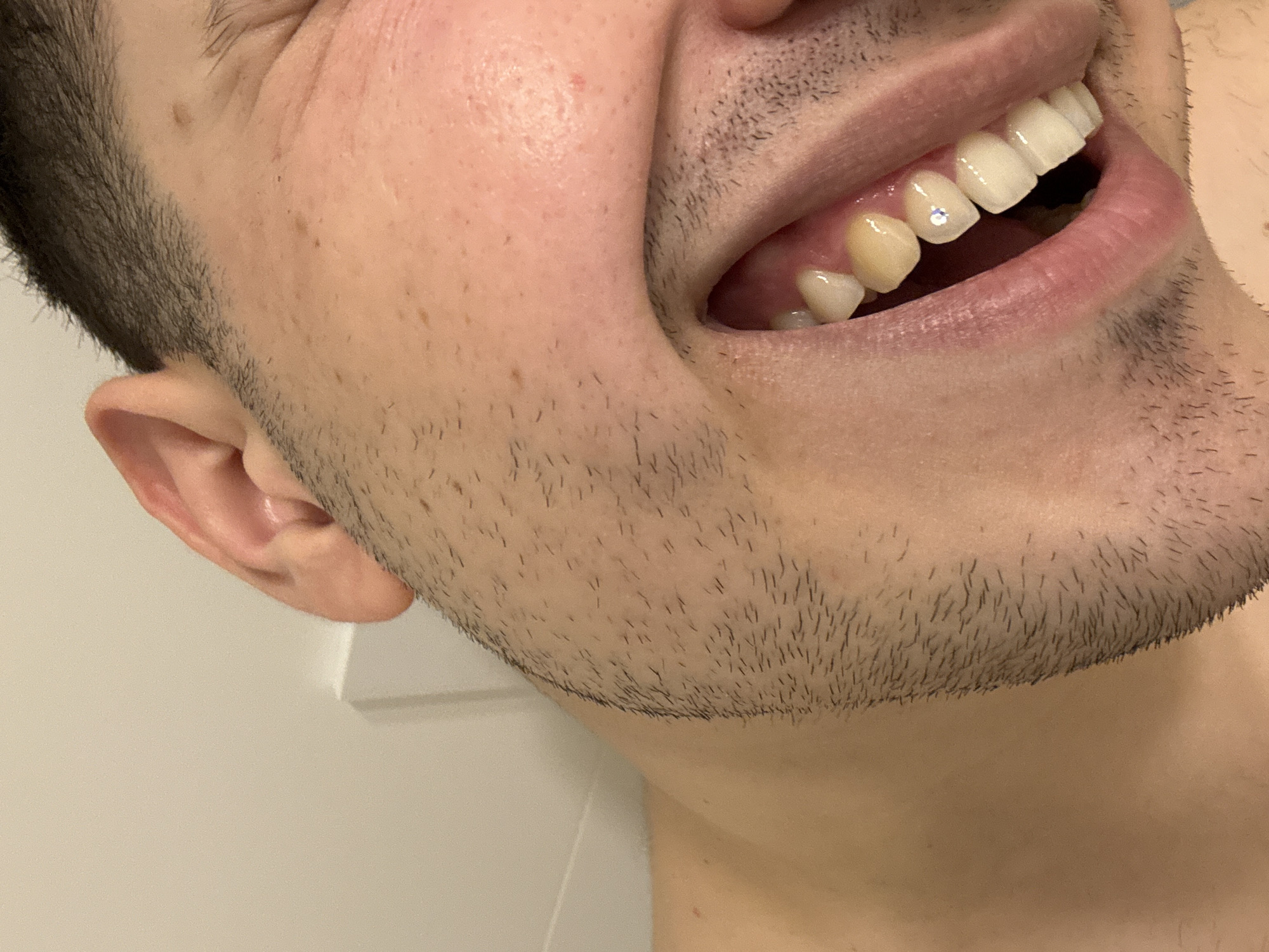 This close-up shot focuses on the lower right side of a person's face, extending from the ear down to the upper chest/neck area. The subject, likely male, is captured mid-laugh or wide smile, with their mouth open.
Visible features include short, dark hair along the sideburn and jawline, transitioning into stubble covering the cheek, jaw, and neck, indicating recent growth. The skin has a light complexion with several small moles or freckles. Part of a natural ear is visible on the left side of the frame.
Inside the widely opened mouth, the teeth and gums are clearly visible. The front upper teeth appear bright white and uniformly shaped, possibly indicating dental work such as veneers or crowns. A small, sparkly jewel or rhinestone is prominently adhered to one of the upper front teeth, specifically an incisor or canine. Further back, another tooth appears more yellowish in contrast to the brighter front teeth. The gums appear healthy and pink.
The background consists of a plain, light-colored surface, likely a white or off-white wall or door, suggesting an indoor setting. The lighting is bright and even. The person's wide smile and open mouth convey strong emotions of happiness, joy, or amusement. There is no visible text in the image. The context for the location is Sofia, Bulgaria.