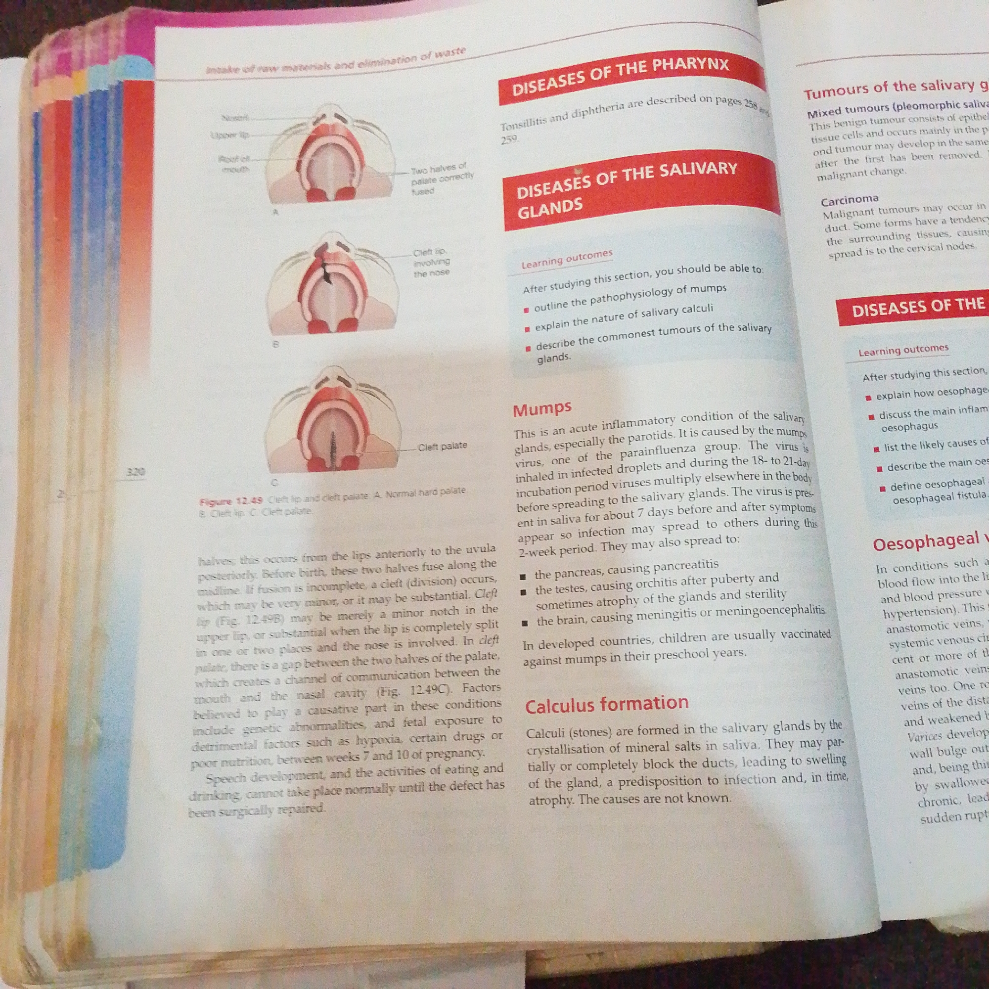 The image is a photograph of an open textbook. The page displays information about medical conditions related to the mouth, throat, and salivary glands. Specifically, it details "Diseases of the Pharynx," "Diseases of the Salivary Glands," and a section on "Mumps." There are also illustrations of a cleft lip and palate. The textbook page includes headings, body text, and learning outcomes. The lower right portion of the image shows text related to "Oesophageal fistula" and "Calculus formation." The environment is a flat surface, likely a table or desk, and the lighting suggests an indoor setting. There are no people or recognizable geographic locations depicted. The text and illustrations are focused on anatomical and pathological information.
