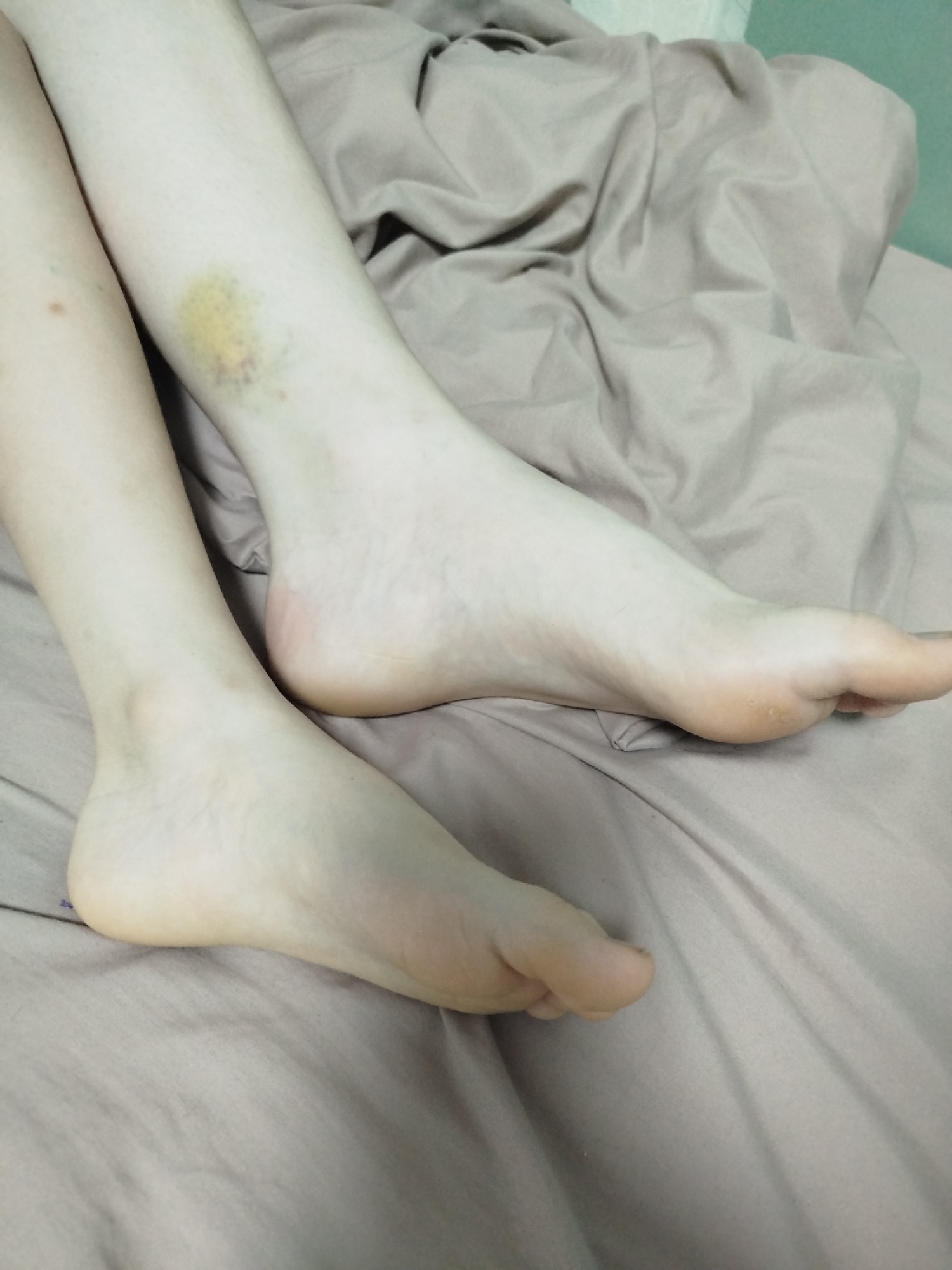 The image displays a close-up view of a person's legs and feet, positioned on a crumpled grey bedsheet. The person's skin appears pale. There is a prominent bruise on the left shin, exhibiting shades of yellow and purple. The feet are bare. The background consists of the bedsheet and a hint of a light green wall or surface. The location of Zavodoukovsk, Russia, is not discernible from the image itself.