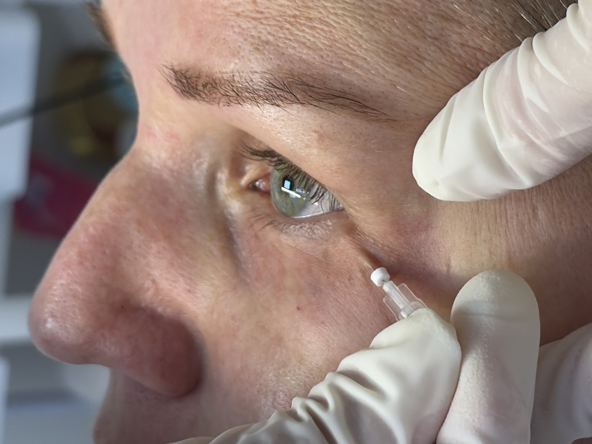 A close-up, high-angle shot shows a person's face with gloved hands performing a procedure near the eye. A gloved hand on the left holds a medical instrument with a needle. Another gloved hand is on the right side of the face, stabilizing the skin. The person's eye is open and looking towards the right, with reflections visible in the iris. The skin appears to have some texture and redness. The background is blurred and suggests an indoor, clinical setting. The location is Unknown, Unknown.