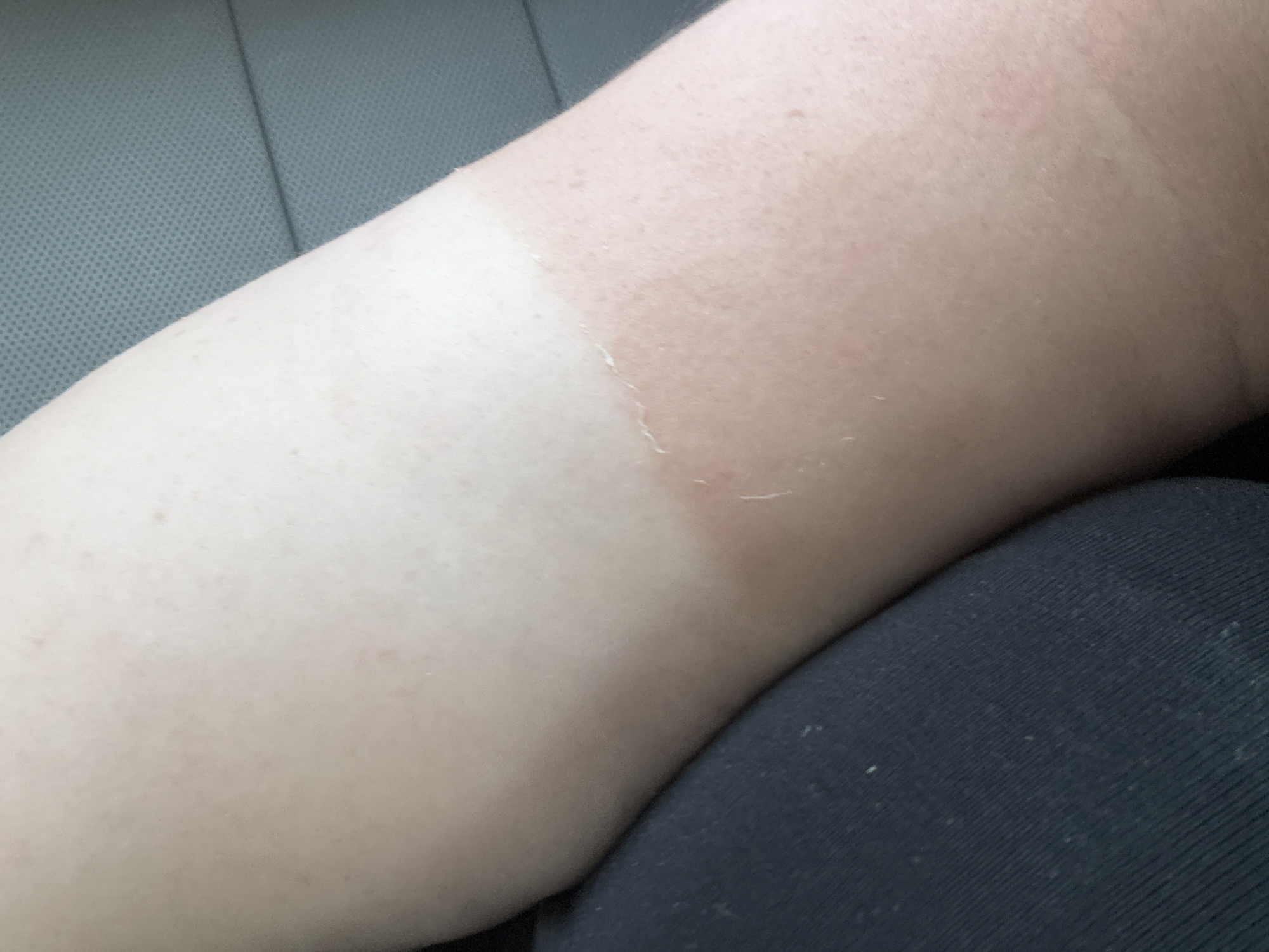 This is a close-up, eye-level medium shot of a person's arm, showing a distinct tan line and some peeling skin, indicative of a recent sunburn. The arm is positioned across a textured gray surface, likely the seat of a vehicle, and partially overlaps with dark fabric, possibly clothing. The lighting suggests an indoor setting, possibly a car interior, with natural light from a window illuminating the arm. There is no visible text or discernible time of day or weather conditions. The overall impression is one of personal experience with sun exposure. The provided location context "Мастоцкі сельскі Савет, Belarus" does not offer any direct visual cues within the image itself.