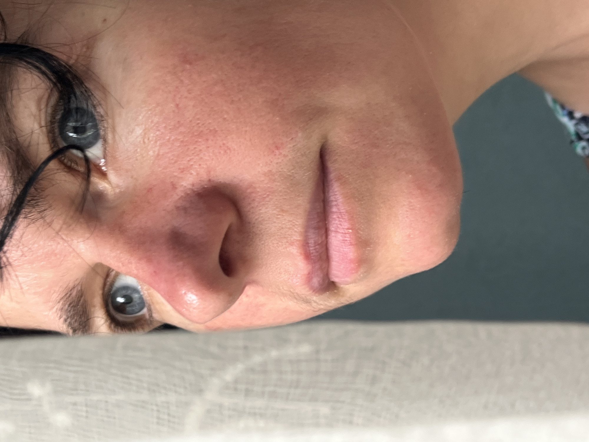 This is a close-up, profile view of a person's face, with a focus on the eye, nose, and mouth. The individual has blue eyes and fair skin with visible pores and some redness, possibly indicating rosacea or an allergic reaction. There are dark, curly hairs framing the forehead and above the eye. A white, textured fabric, possibly a curtain or sheer blind, is visible on the left side of the frame, suggesting an indoor setting near a window. The background consists of a dark teal wall. The scene does not provide any information about the specific location within ღრმაღელის თემი, Georgia.