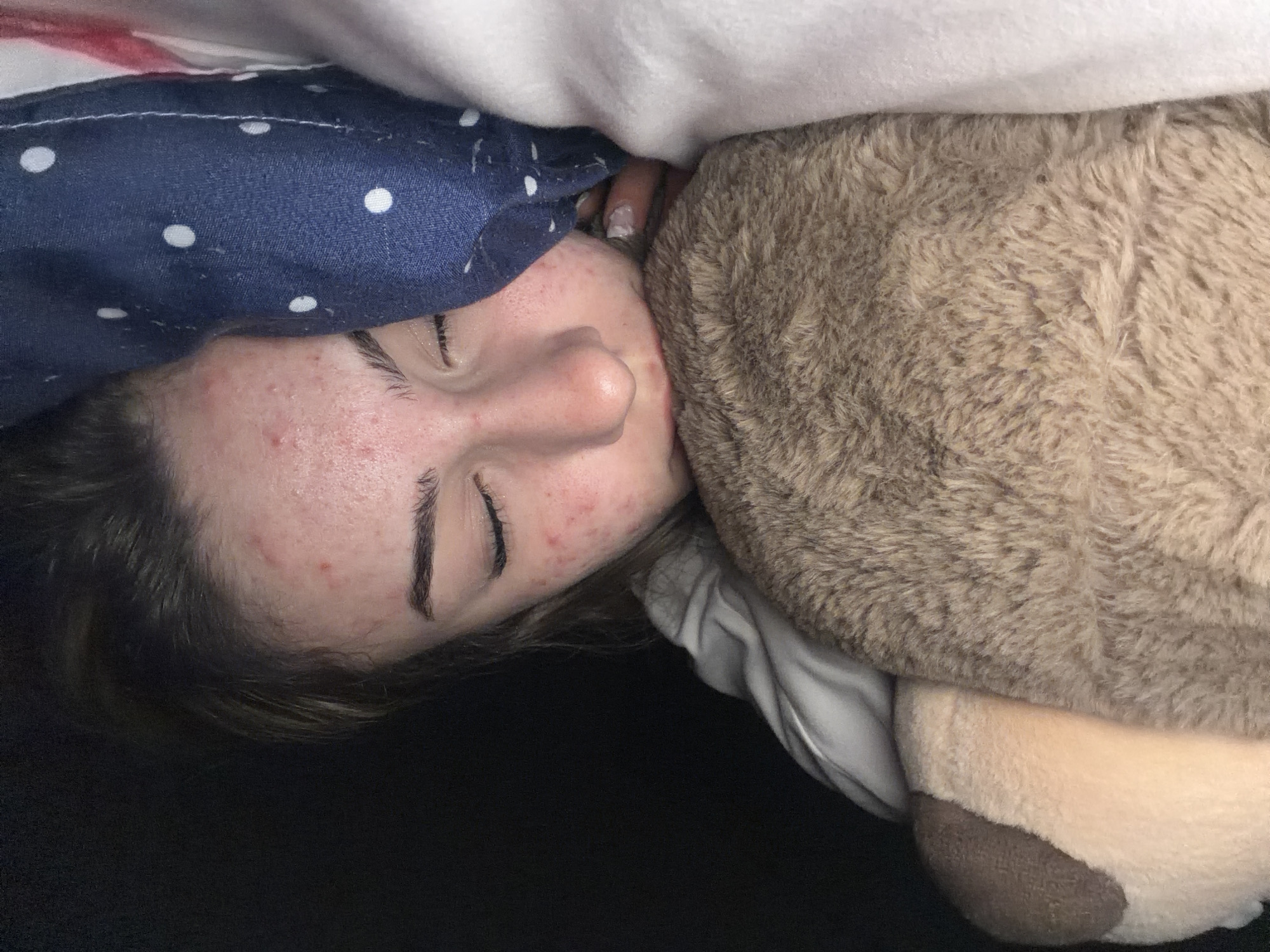 The image shows a close-up view of a young woman sleeping, nestled against a stuffed animal and a pillow. She is lying on her side, with her eyes closed. Her face, particularly her forehead and cheeks, shows signs of acne. The stuffed animal is a light brown color with a darker brown patch on its ear. The pillow is dark blue with white polka dots. The bedding appears to be white. The background is dark and out of focus, suggesting an indoor environment. There is no discernible information in the image to indicate the location in the city of Shumen, Bulgaria.