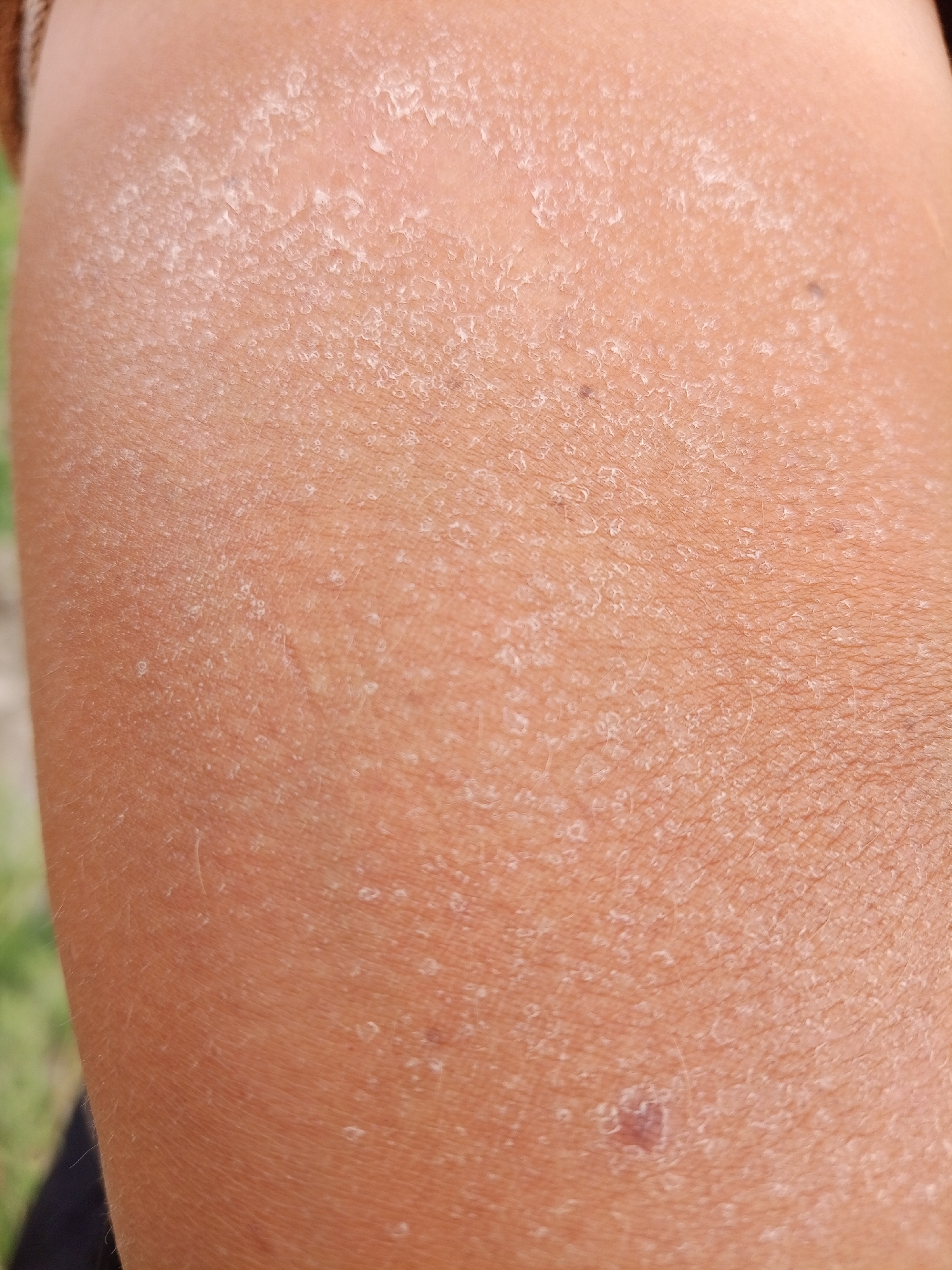 The image is a close-up of sunburnt skin, likely on an arm or leg. The skin is peeling and dry, with visible flakiness and some small, raised bumps. There is a small, reddish-brown mole visible on the lower right portion of the image. The background is blurred and appears to be green grass, suggesting an outdoor setting. There is no indication of the city of Pankrushikha, Russia in the image.