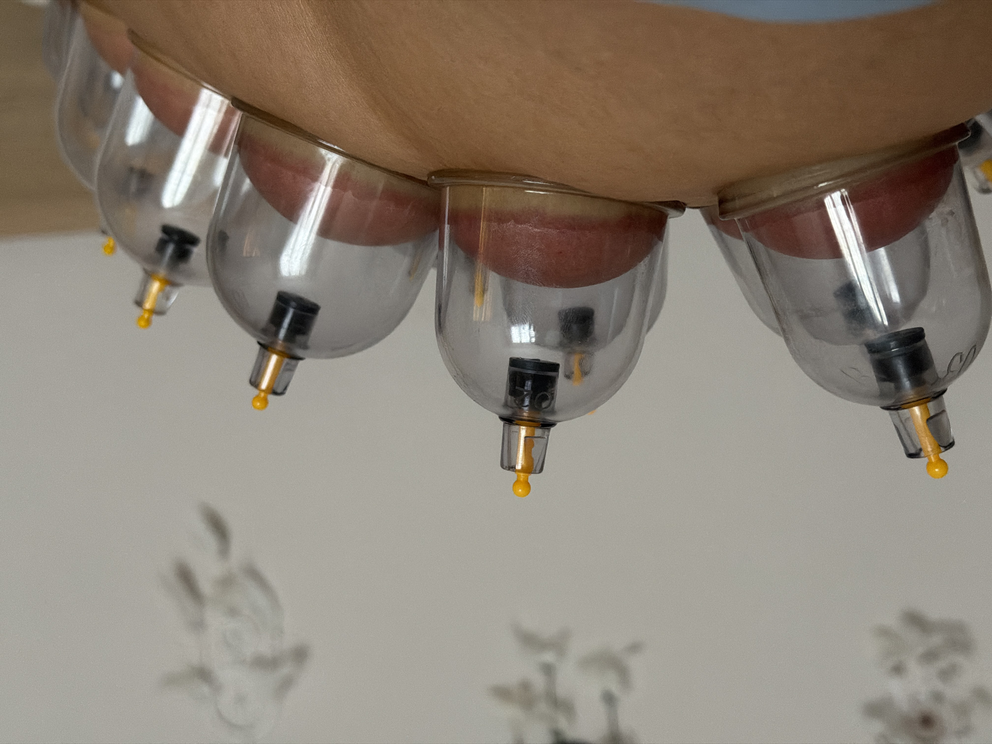 The image shows several clear plastic cups attached to a person's skin, presumably for a cupping therapy session. The skin is pulled up into the cups, creating a raised, reddish area. Each cup has a black and yellow valve at the bottom. The background is a blurred white wall with faint patterns. The location in Saint Petersburg, Russia, cannot be determined from the provided image.