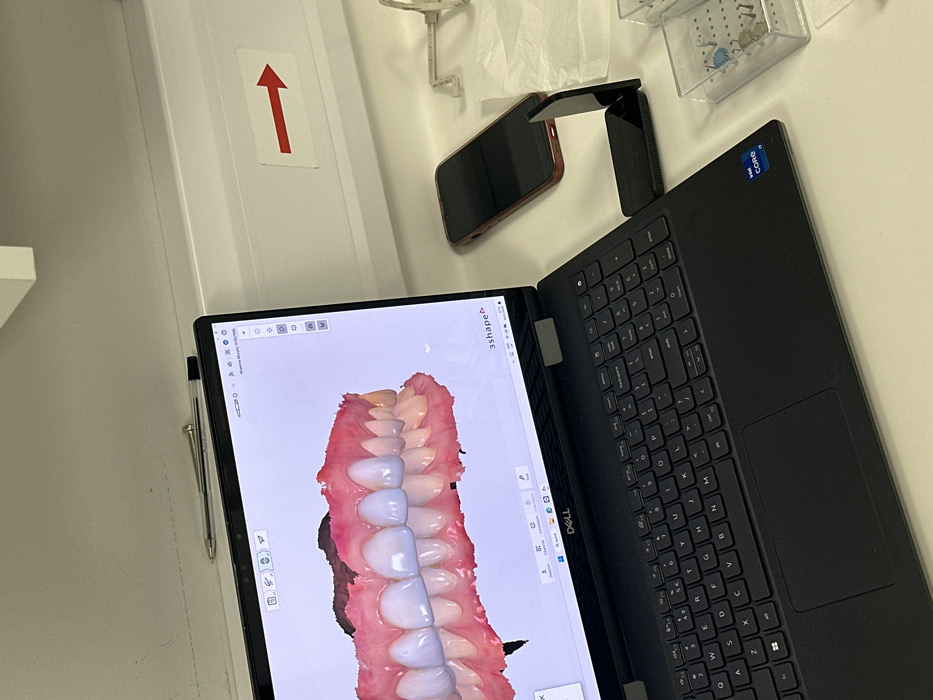 The image depicts a clean, well-lit dental laboratory or office workspace in Tunbridge Wells, United Kingdom. The primary focus is a black Dell laptop, positioned open on a white counter. Its screen displays a 3D digital model of a human dental arch from a software interface branded "3shape," showing pink gum tissue and a full set of teeth. The upper anterior teeth are rendered in a distinctly lighter, whiter shade than the posterior or lower teeth, suggesting a digital design for cosmetic veneers or crowns. Visible on the screen are the name "Klaudia Murphy" and a date "15/10/XXXX".
To the right of the laptop, a red-cased smartphone is placed face down. Adjacent to the laptop's right side, a small, black, angled electronic accessory, possibly a stand or hub, rests on the counter. Further right, a transparent plastic container with multiple compartments holds numerous small, blue-headed and beige-bodied dental pins or components. A partially visible white dental articulation device or similar tool is also present on the counter.
In the background, a white wall or shelving unit features a red arrow sticker pointing to the right. A clear ballpoint pen is visible resting horizontally on a white ledge above the laptop screen.