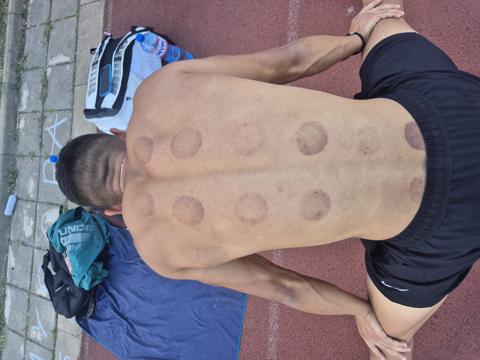 The image shows the back of a shirtless person with cupping marks. The person is lying on a blue mat on a red athletic track. To the left of the person, there is a black backpack, a teal t-shirt with "UNDER ARMOUR" printed on it, and a water bottle. A white and black backpack with a blue phone in a clear pouch is also visible in the upper left corner of the image, with a blue bottle of "DEVIN" water next to it. The scene appears to be outdoors on a sunny day, indicated by the bright lighting and shadows. The cupping marks suggest the person may have recently undergone or is recovering from a therapeutic treatment. The location is identified as Burgas, Bulgaria.