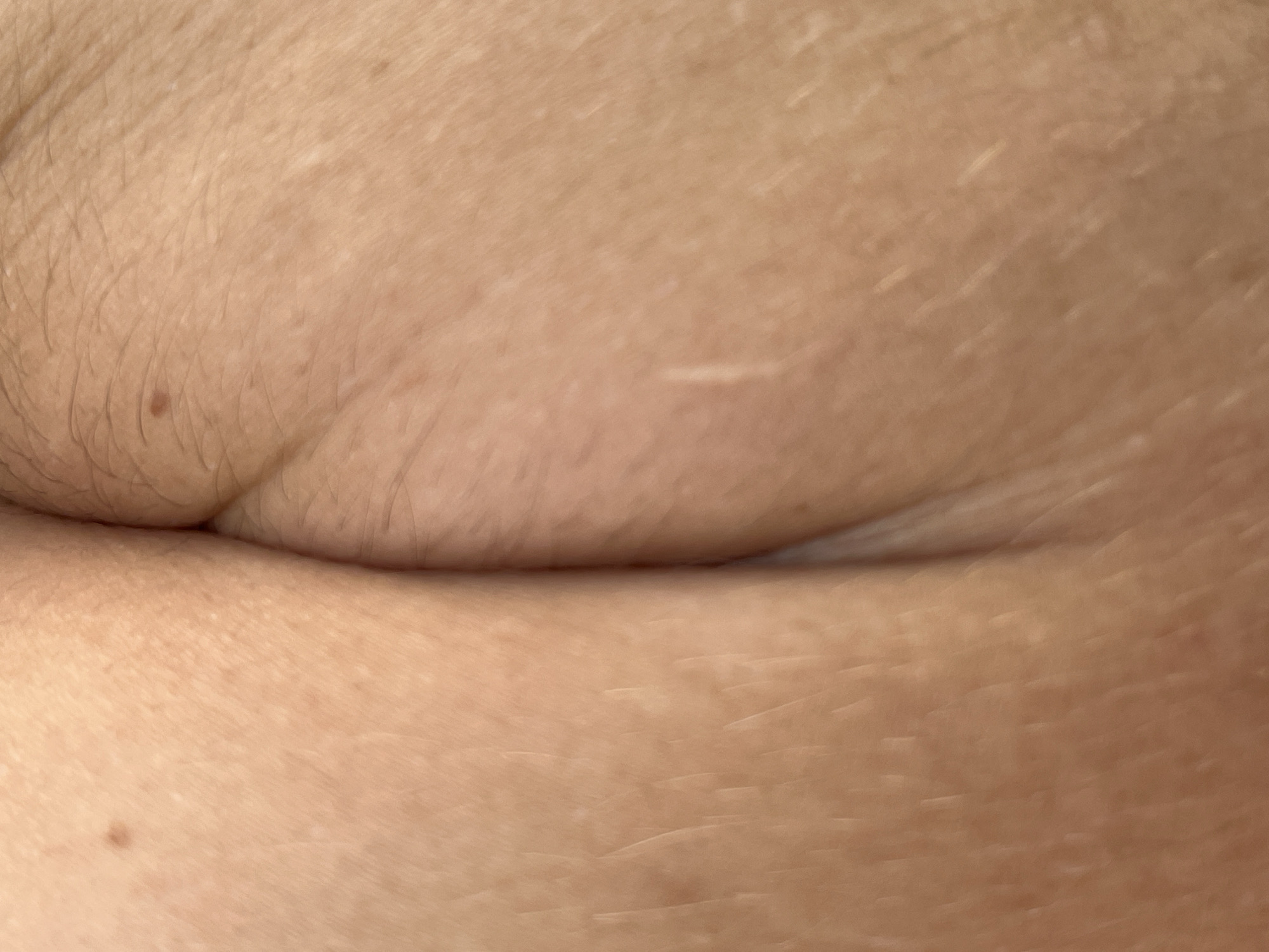 The image shows human skin, likely from the abdomen area. There is a skin fold and some hair present. A small mole is visible, as well as a faint scar. No information in the image indicates a location in the city of Chaikovsky, Russia.