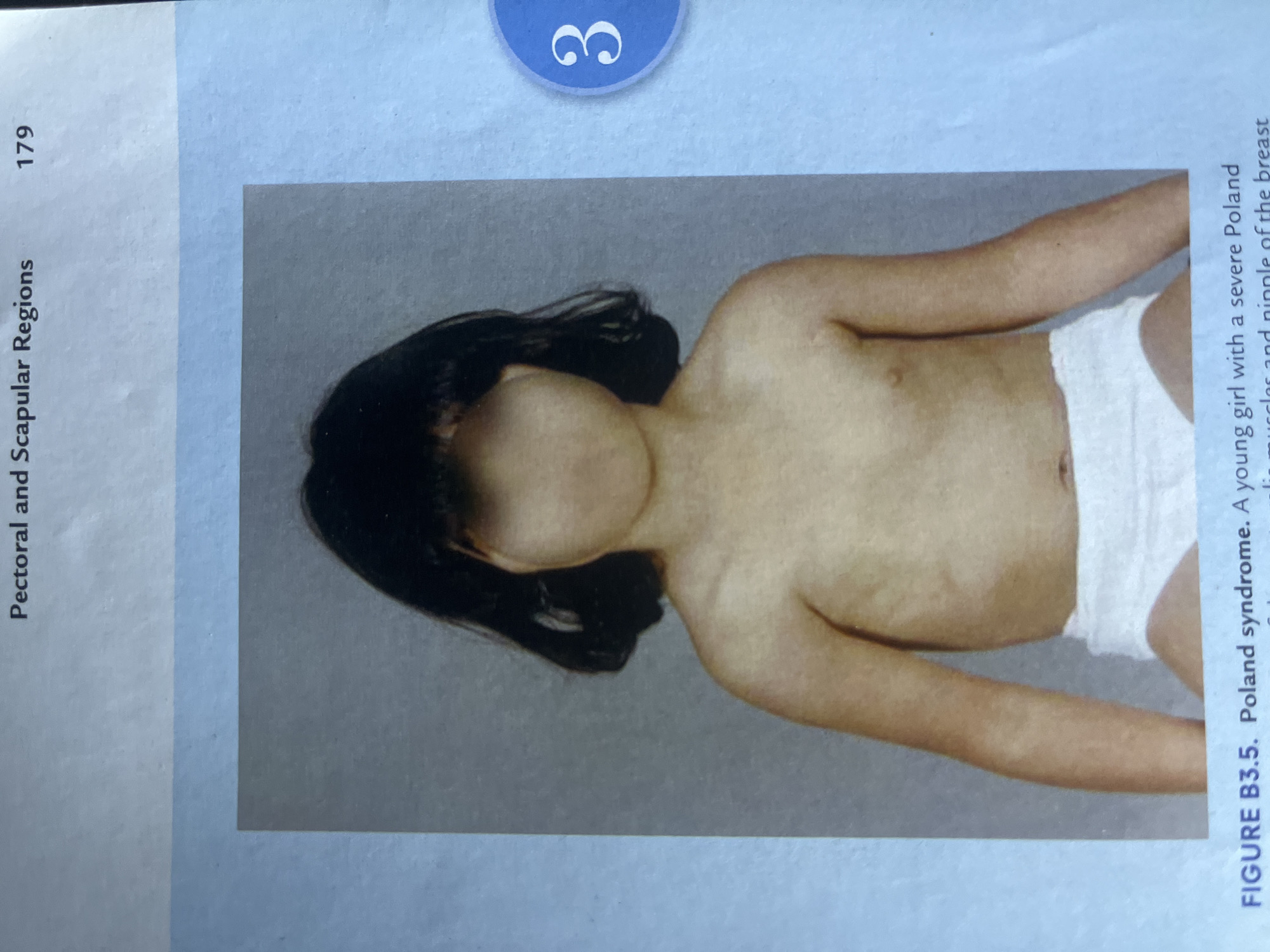 The image shows a close-up of a young girl from the chest up, with her face blurred out. She has dark hair and is wearing a white garment around her waist. Her chest and arms are visible. The background is a plain, light blue color. To the right of the girl, there is a blue circle with the number "3" in white. Below the image, there is text that reads "FIGURE B3.5. Poland syndrome. A young girl with a severe Poland".
There is no information in the image to suggest any connection to Jalingo, Nigeria.