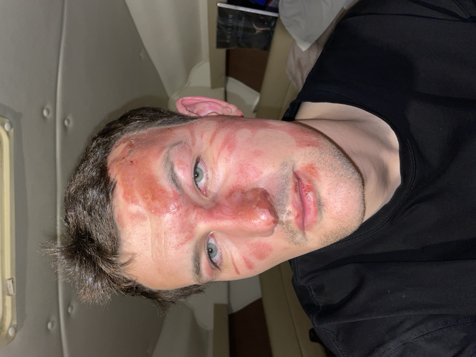 A male individual with dark hair and light eyes is depicted in a close-up, chest-up photograph within an interior setting. He presents with extensive facial injuries, characterized by widespread erythema, blistering, and superficial abrasions across the forehead, periorbital regions, nose, cheeks, and around the mouth. The nose appears swollen and abraded, and the lips exhibit abrasions with evidence of dried blood. He is wearing a black crew-neck t-shirt and is looking directly at the camera. The background consists of a light-colored, curved ceiling with visible fasteners, indicative of a marine vessel cabin. To the subject's right, a dark object resembling a book titled "PHANTOM" and a white pillow are partially visible. This scene is located within a boat cabin in the city of Sochi, Russia.