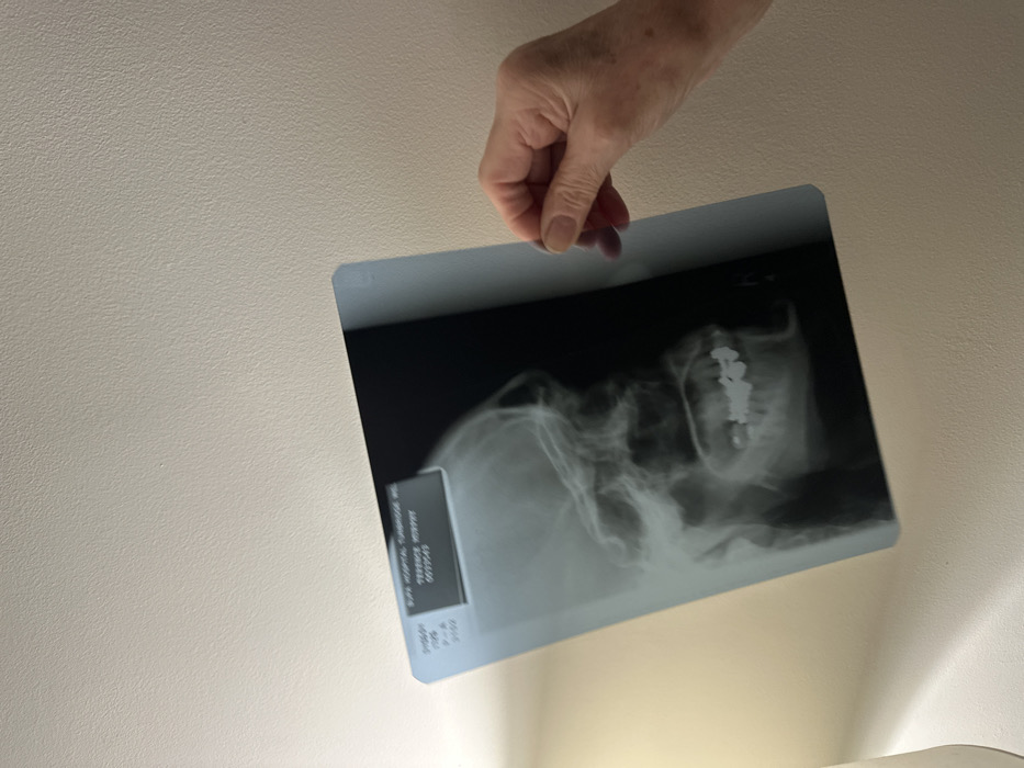 A hand holds an x-ray film against a plain, off-white background. The x-ray depicts a profile view of a skull and neck. The skeletal structure is visible in varying shades of gray. There are some bright white spots in the neck, which could indicate screws. A dark rectangle with white text, possibly identification information, is visible at the top left corner of the x-ray. Light from below illuminates the bottom right corner.