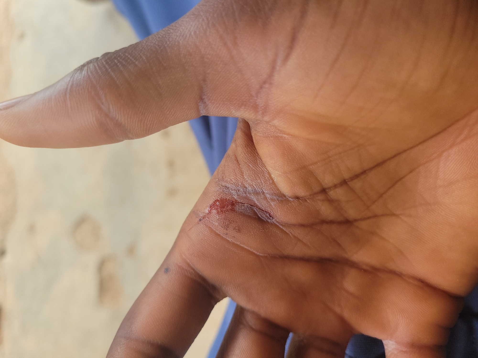 The image shows a close-up of a dark-skinned human hand, palm up, with a fresh laceration on the skin between the base of the thumb and the palm. There is a small amount of blood visible. The hand appears otherwise clean. The background is blurry, but appears to be a sandy or light-colored outdoor setting. There is no verifiable information related to the city of Jos, Nigeria.
