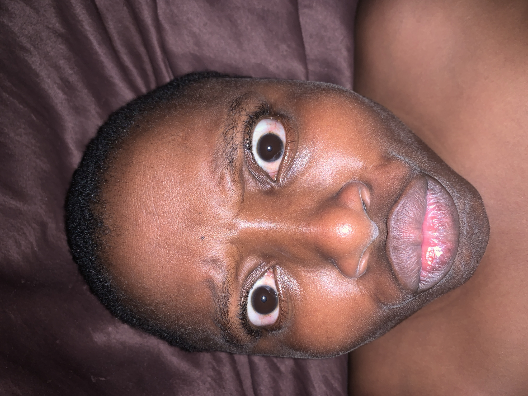 A close-up, downward-facing image shows the face of a person with dark skin. The person has dark eyes and short, dark hair. The lips appear chapped and possibly inflamed. The background consists of dark, brown fabric, possibly bedding. There is no indication of Ikorodu, Nigeria, or any specific location. The only subject in the photo is the person's face.