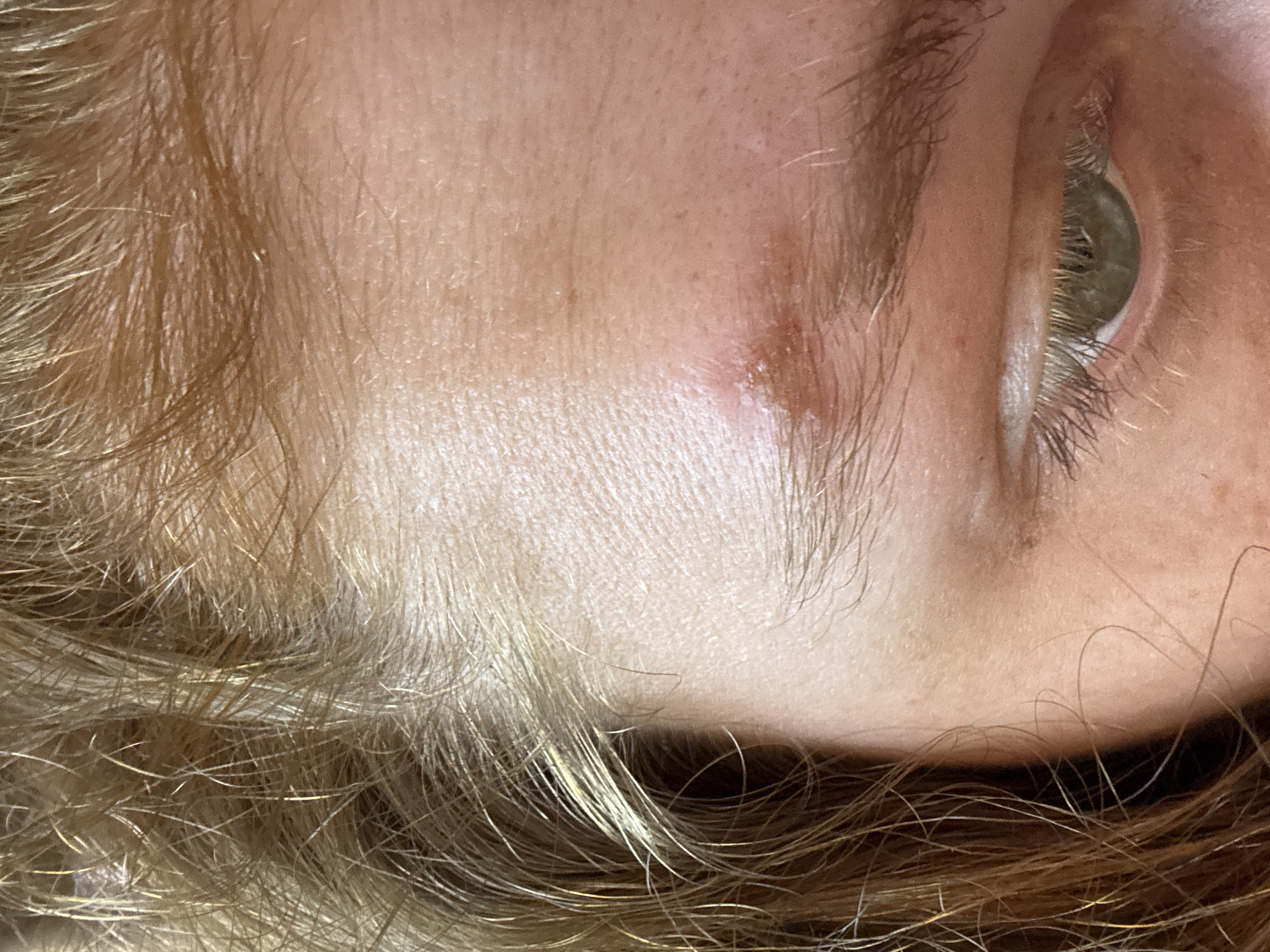 A close-up, rotated portrait captures a section of a person's face, specifically their right eye, eyebrow, and surrounding skin and hair. The person has a fair complexion, with light brown or blond hair that appears fine-textured and falls across the forehead and temple. Their right eye features a green or hazel iris and long, dark eyelashes, with the eyelid appearing relaxed. A notable detail is a patch of reddish, slightly raised skin on the forehead, near the outer part of the eyebrow, indicating a skin irritation or blemish. The lighting is soft and even, suggesting an indoor environment or diffused natural light. No specific activity or emotion is discernible, and there is no visible text. The image offers a detailed view of these facial features without providing broader context about the subject or their location in Buenos Aires, Argentina.